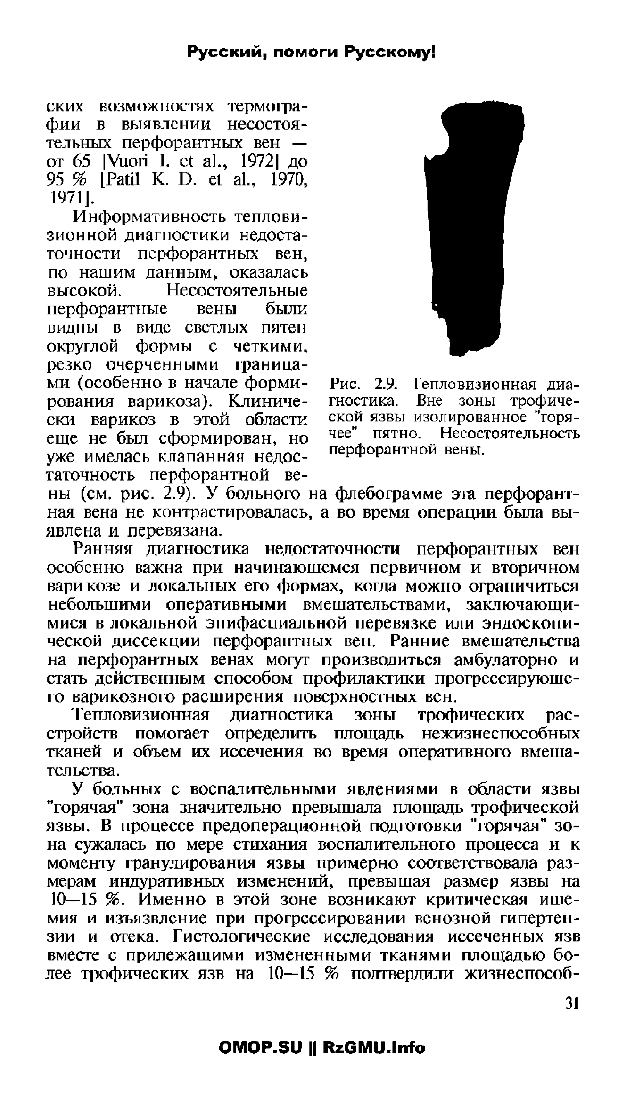 Рис. 2.9. Тепловизионная диагностика. Вне зоны трофической язвы изолированное "горячее" пятно. Несостоятельность перфорантной вены.