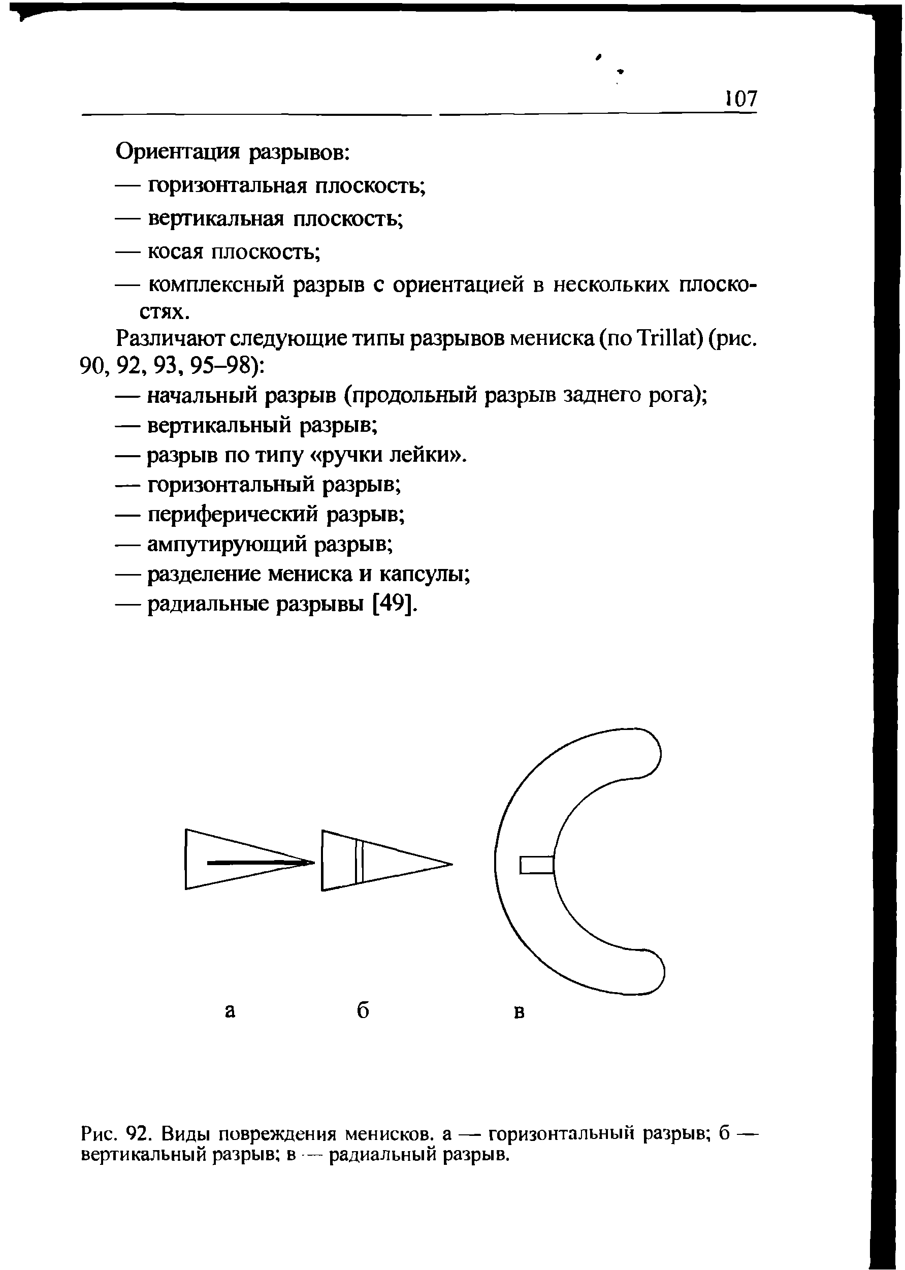 Рис. 92. Виды повреждения менисков, а — горизонтальный разрыв б — вертикальный разрыв в — радиальный разрыв.