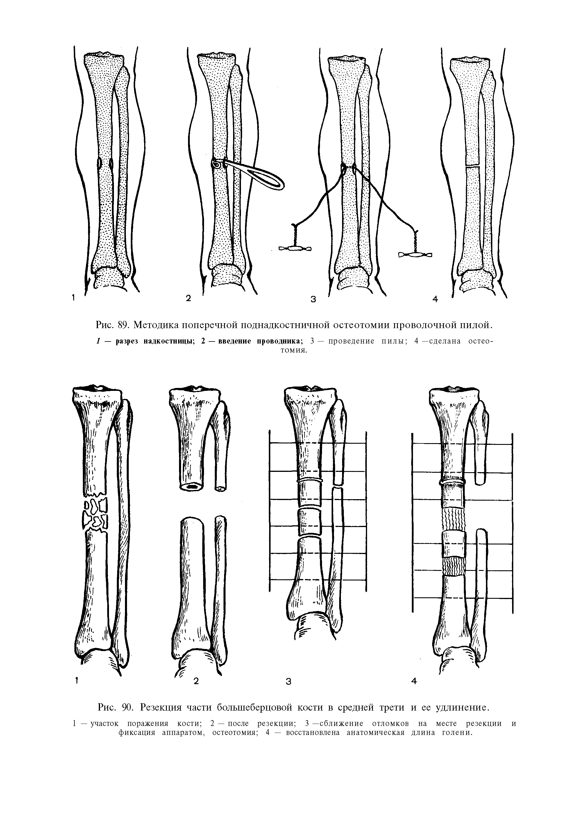 Рис. 90. Резекция части большеберцовой кости в средней трети и ее удлинение.