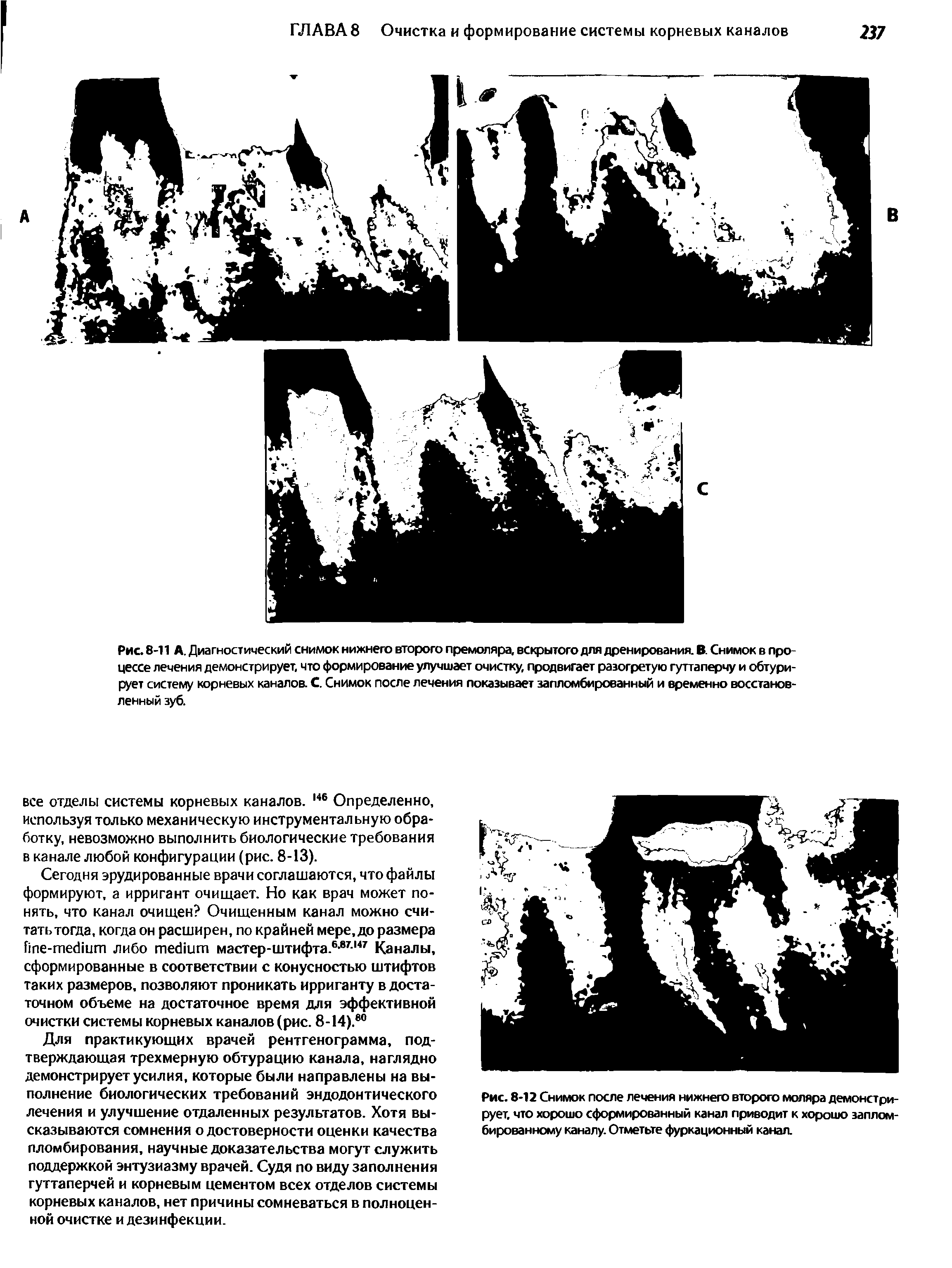 Рис. 8-11 А. Диагностический снимок нижнего второго премоляра, вскрытого для дренирования. В. Снимок в процессе лечения демонстрирует, что формирование улучшает очистку, продвигает разогретую гуттаперчу и обтурирует систему корневых каналов. С. Снимок после лечения показывает запломбированный и временно восстановленный зуб.