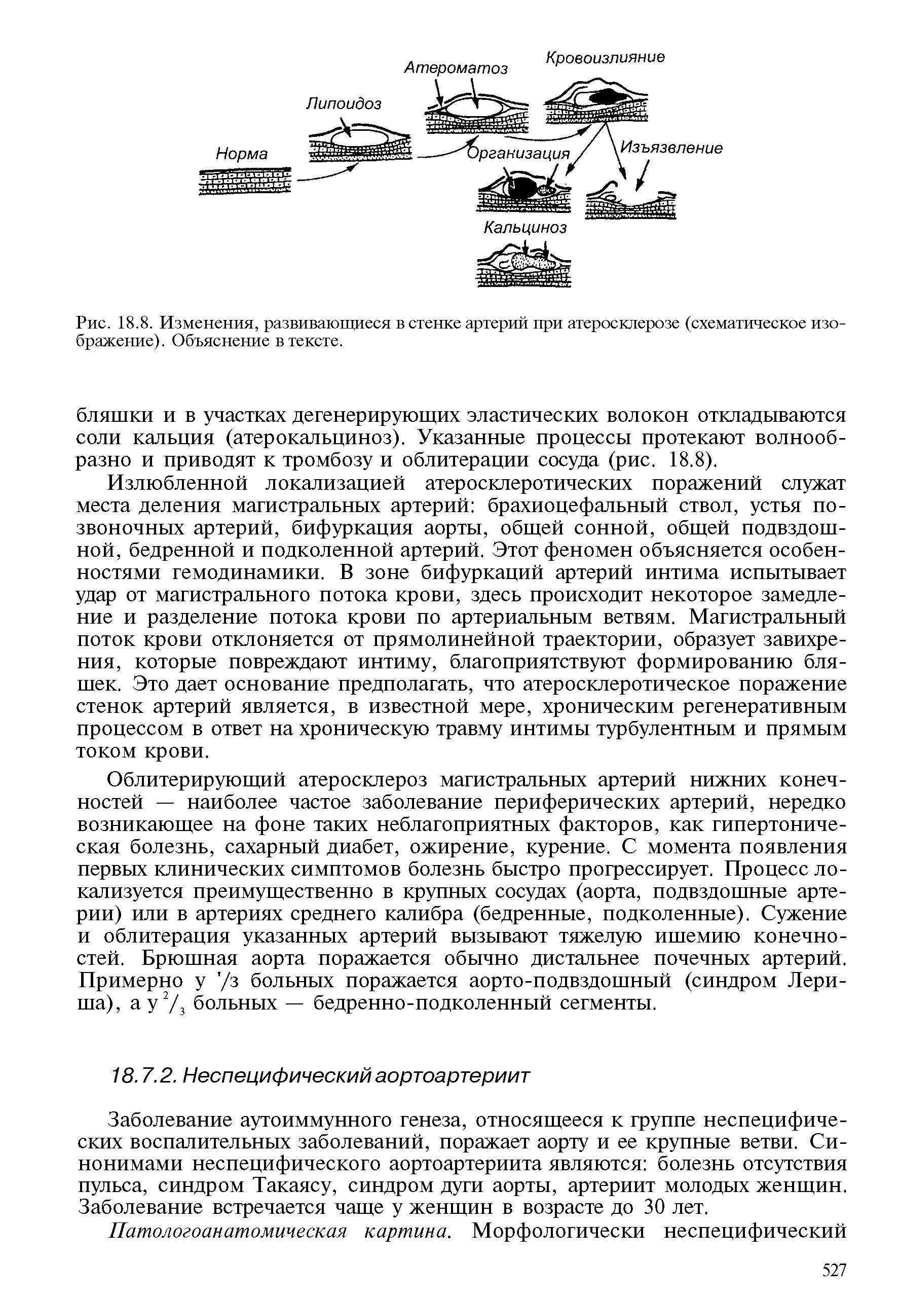 Рис. 18.8. Изменения, развивающиеся в стенке артерий при атеросклерозе (схематическое изображение). Объяснение в тексте.