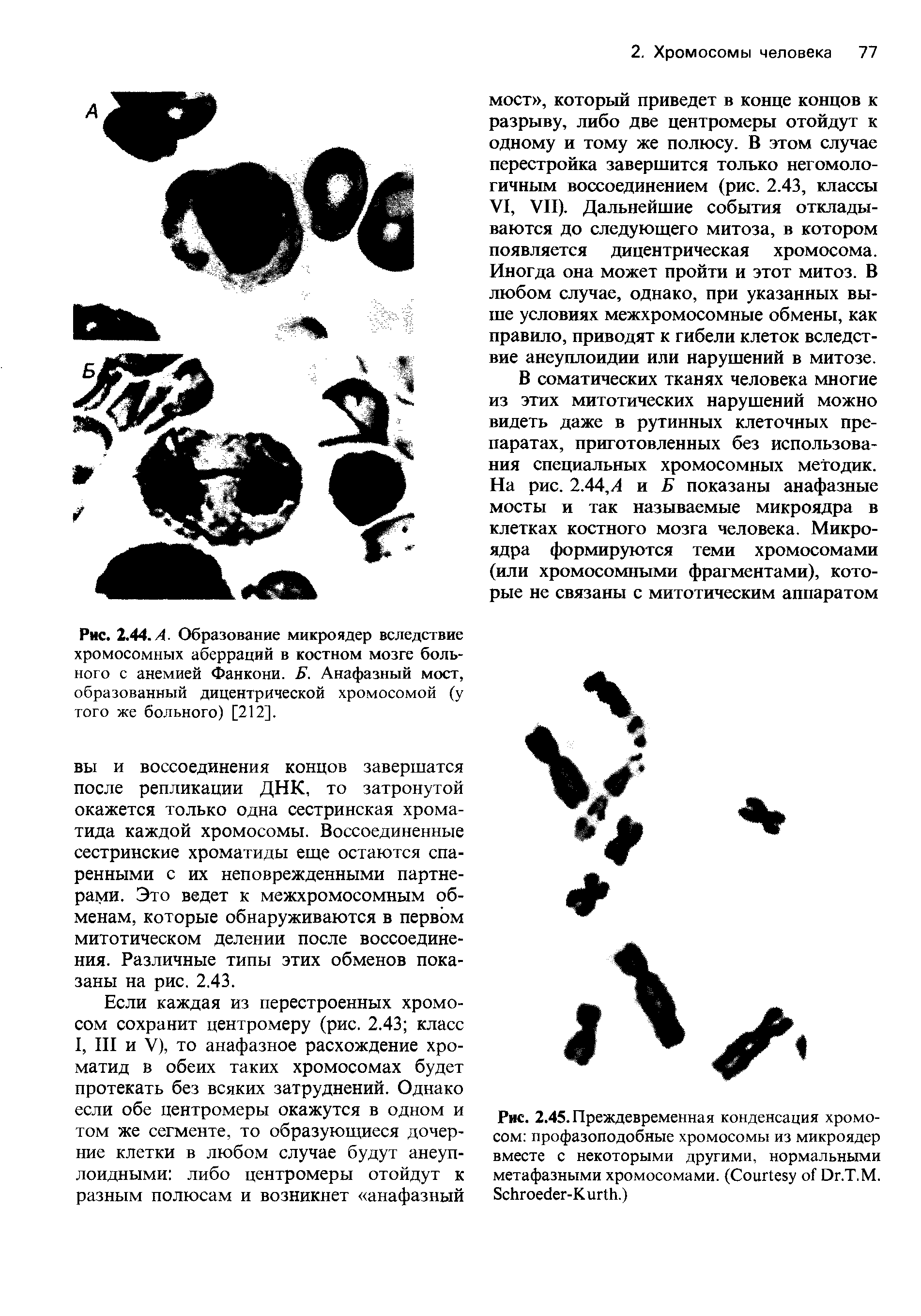 Рис. 2.44.Л. Образование микроядер вследствие хромосомных аберраций в костном мозге больного с анемией Фанкони. Б. Анафазный мост, образованный дицентрической хромосомой (у того же больного) [212].