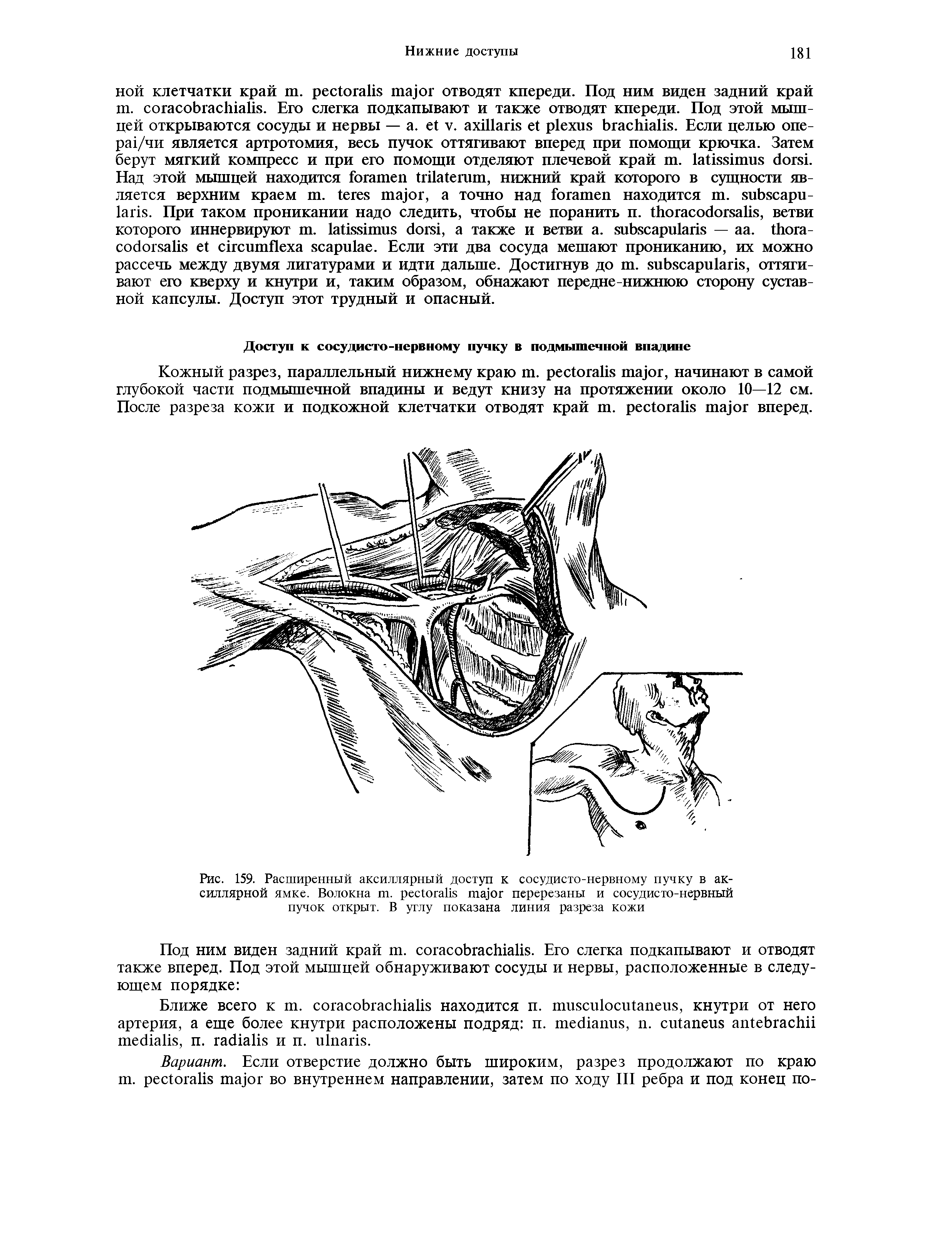 Рис. 159. Расширенный аксиллярный доступ к сосудисто-нервному пучку в ак-силлярной ямке. Волокна . перерезаны и сосудисто-нервный пучок открыт. В углу показана линия разреза кожи...