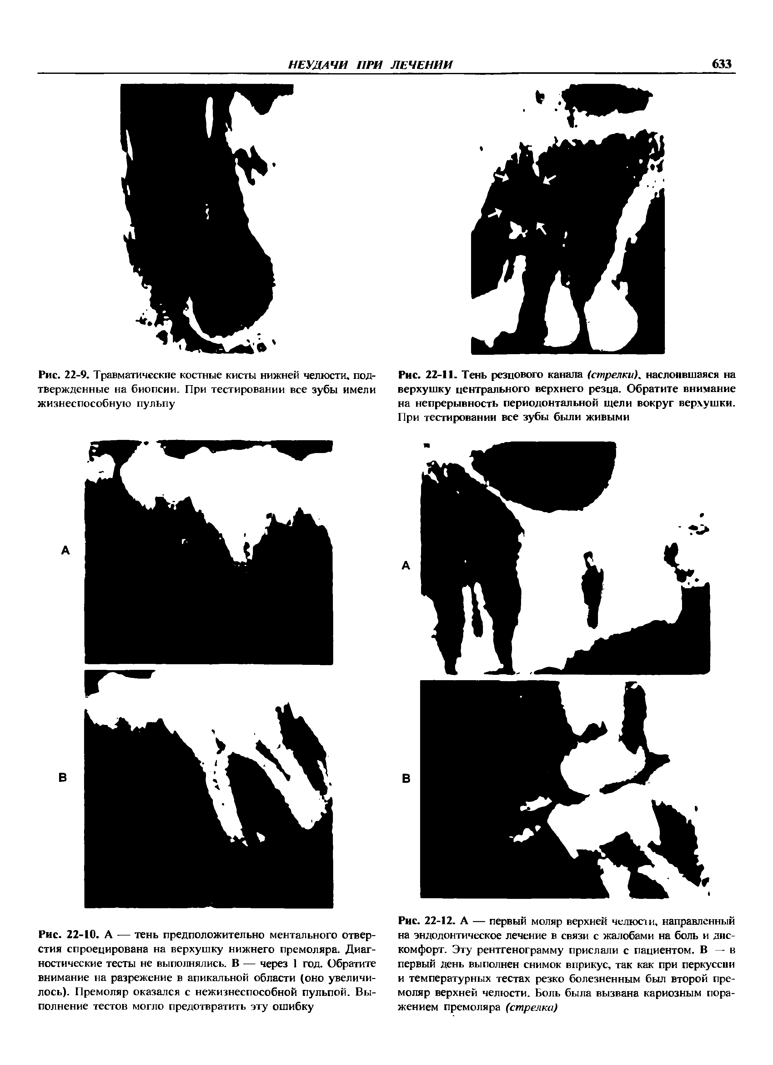 Рис. 22-12. А — первый моляр верхней челюши, направленный на эндодонтическое лечение в связи с жалобами на боль и дискомфорт. Эту рентгенограмму прислали с пациентом. В — в первый день выполнен снимок вприкус, так как при перкуссии и температурных тестах резко болезненным был второй премоляр верхней челюсти. Боль была вызвана кариозным поражением премоляра (стрелка)...