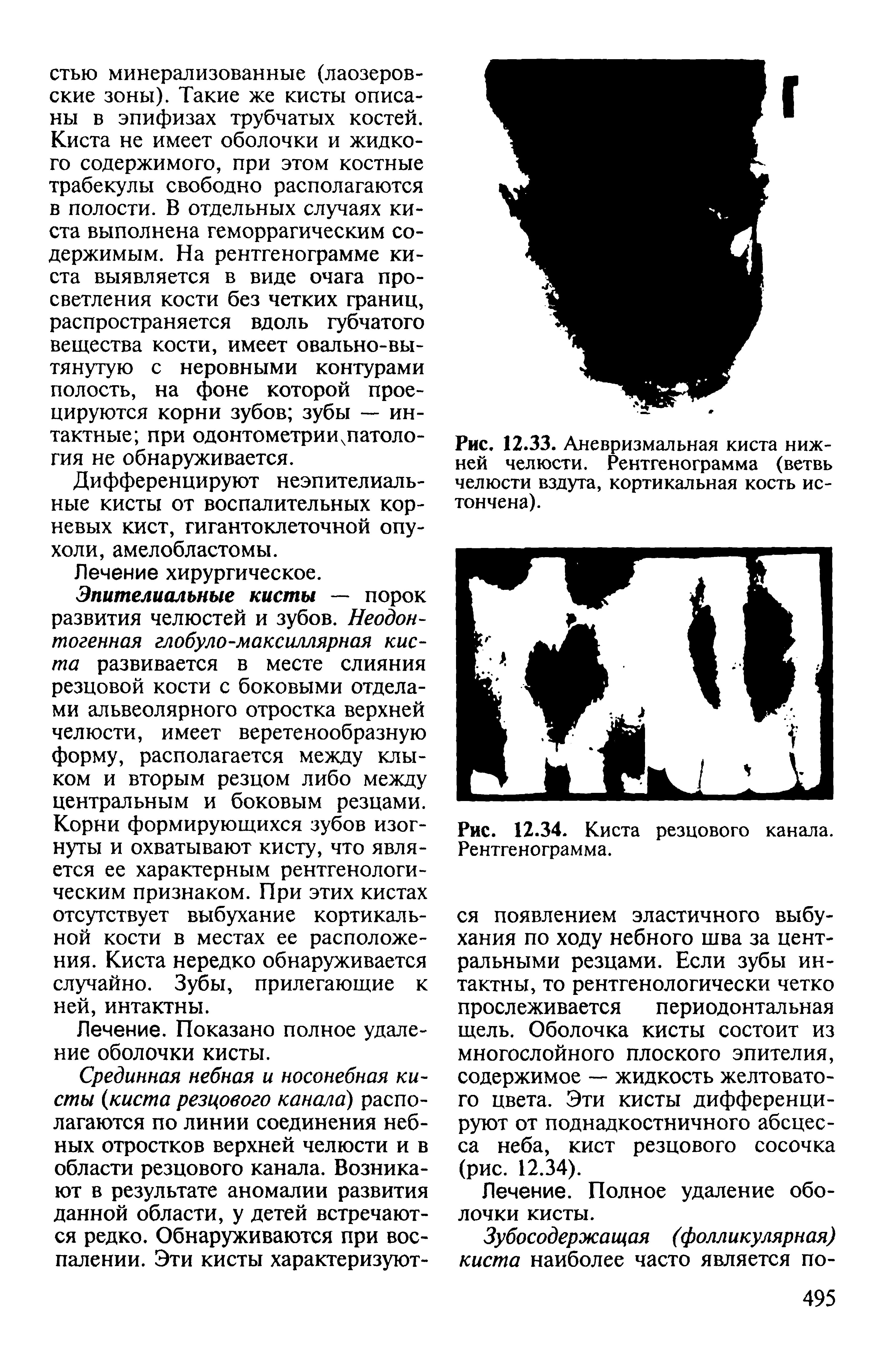 Рис. 12.33. Аневризмальная киста нижней челюсти. Рентгенограмма (ветвь челюсти вздута, кортикальная кость истончена).