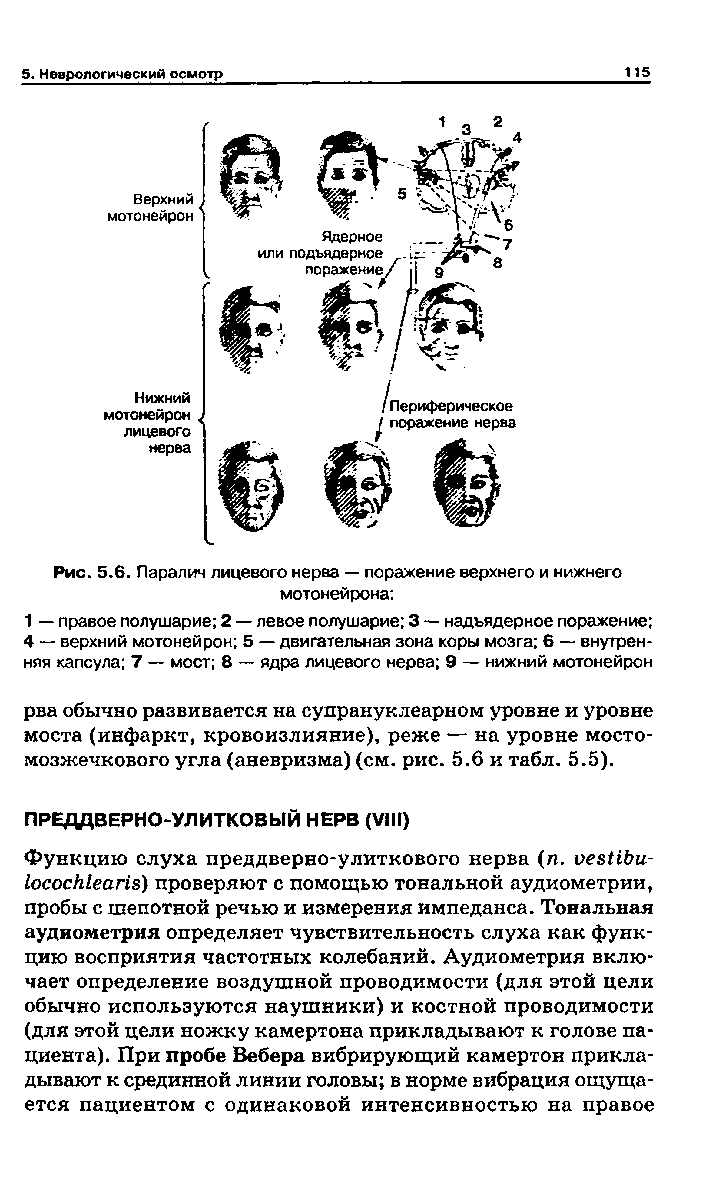 Рис. 5.6. Паралич лицевого нерва — поражение верхнего и нижнего мотонейрона ...