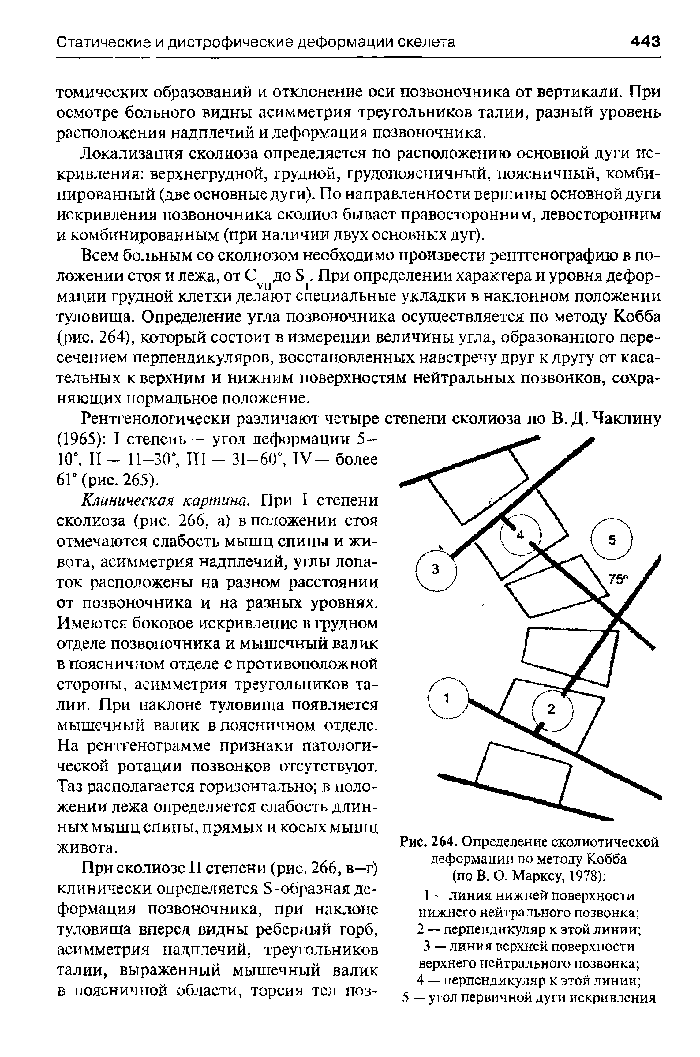 Рис. 264. Определение сколиотической деформации по методу Кобба (по В. О. Марксу, 1978) ...