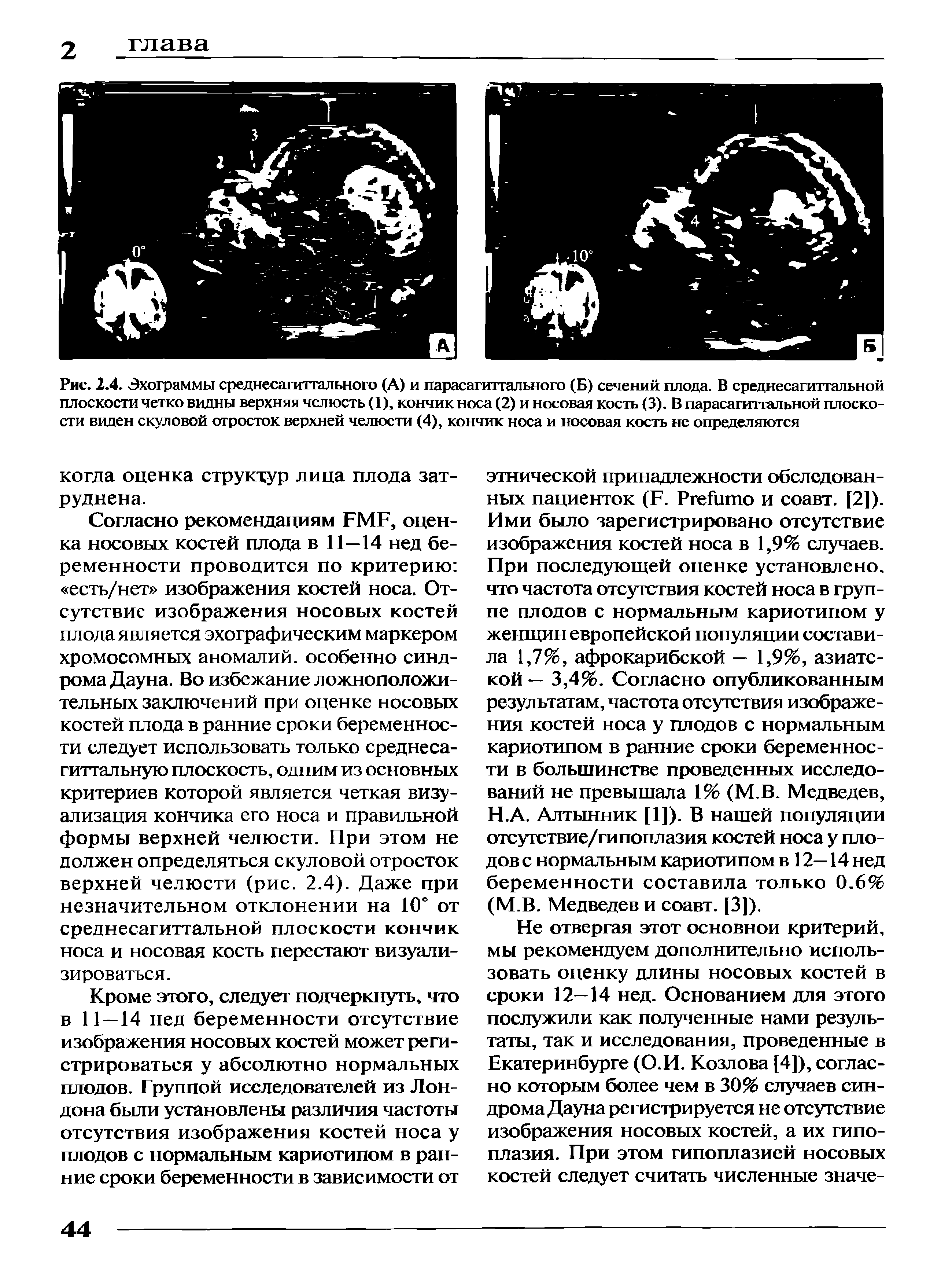 Рис. 2.4. Эхограммы среднесагиттального (А) и парасагиттального (Б) сечений плода. В среднесагиттальной плоскости четко видны верхняя челюсть (1), кончик носа (2) и носовая кость (3). В парасагиттальной плоскости виден скуловой отросток верхней челюсти (4), кончик носа и носовая кость не определяются...