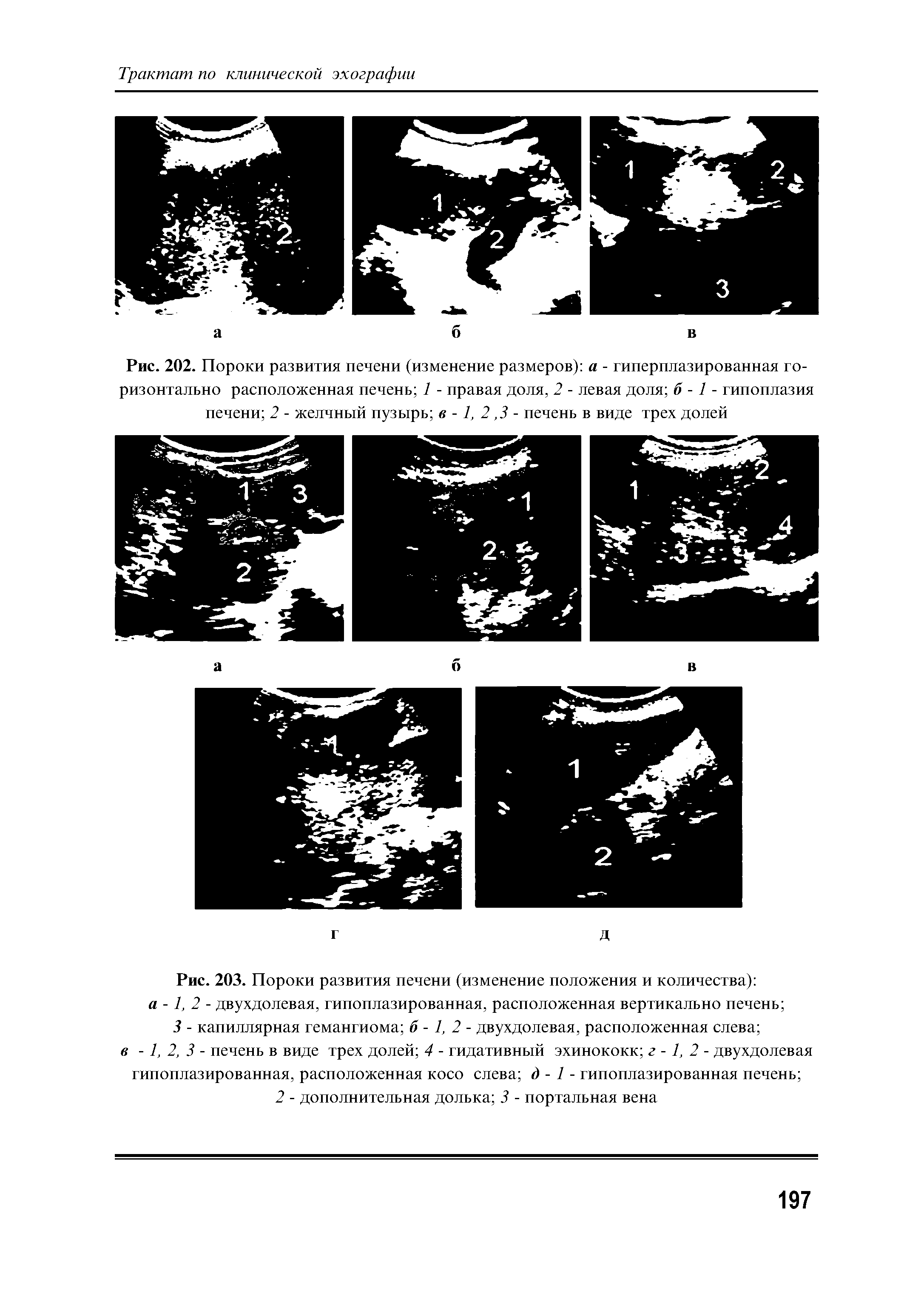 Рис. 202. Пороки развития печени (изменение размеров) а - гиперплазированная горизонтально расположенная печень 1 - правая доля, 2 - левая доля б -1 - гипоплазия печени 2 - желчный пузырь в -1, 2,3 - печень в виде трех долей...