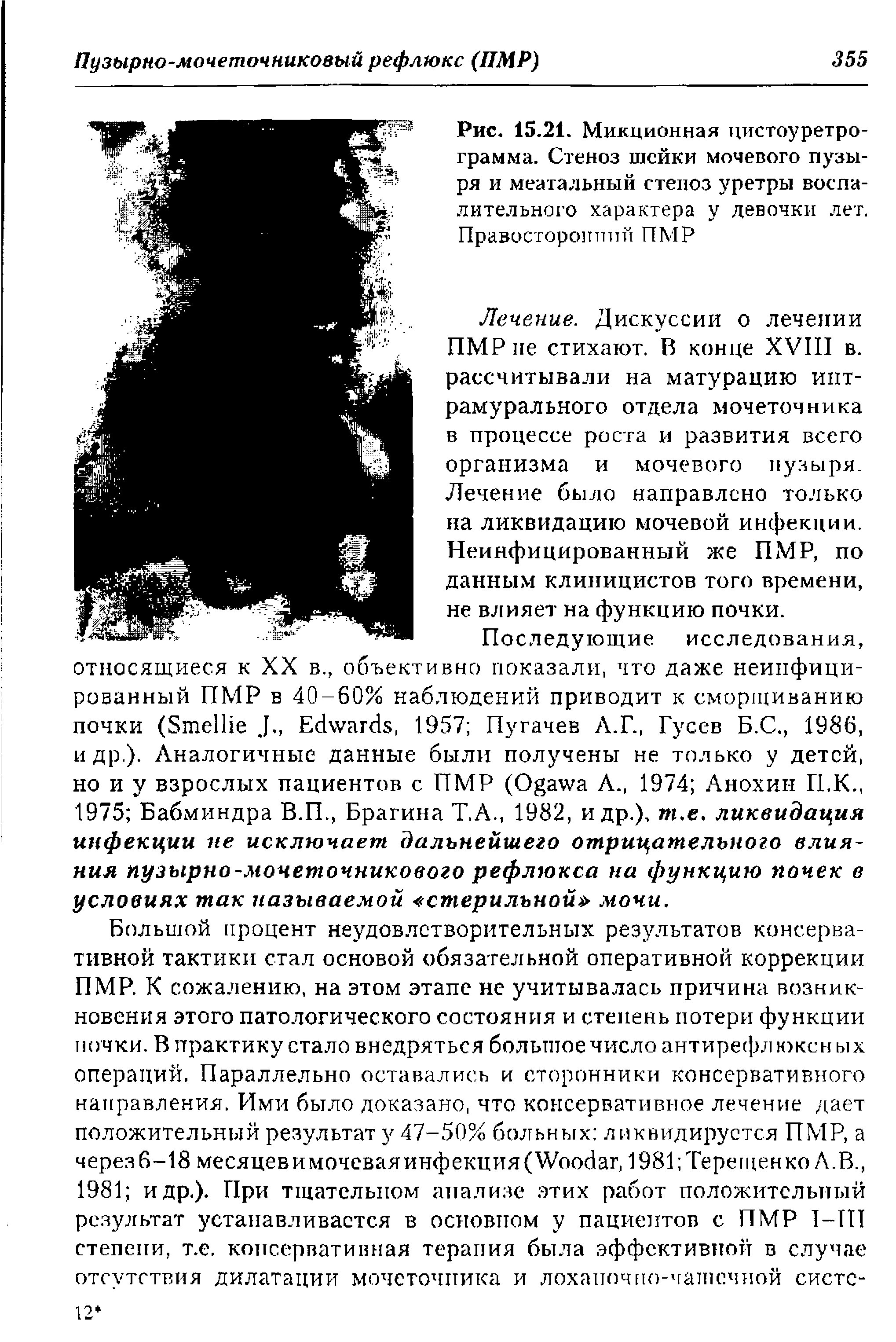 Рис. 15.21. Микционная цистоуретро-грамма. Стеноз шейки мочевого пузыря и меатальный стеноз уретры воспалительного характера у девочки лет. Правосторонний ПМР...