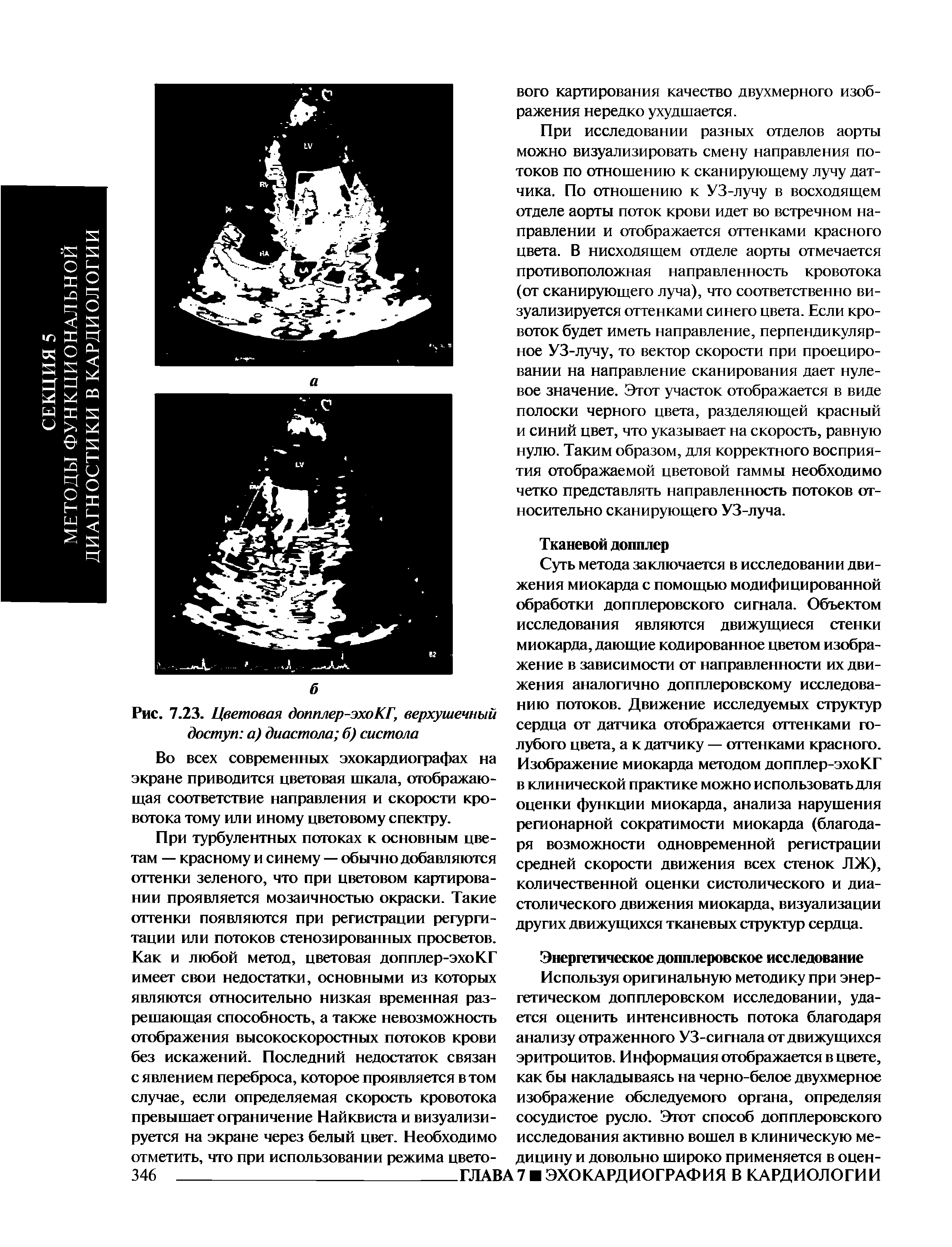 Рис. 7.23. Цветовая допплер-эхоКГ, верхушечный доступ а) диастола б) систола...