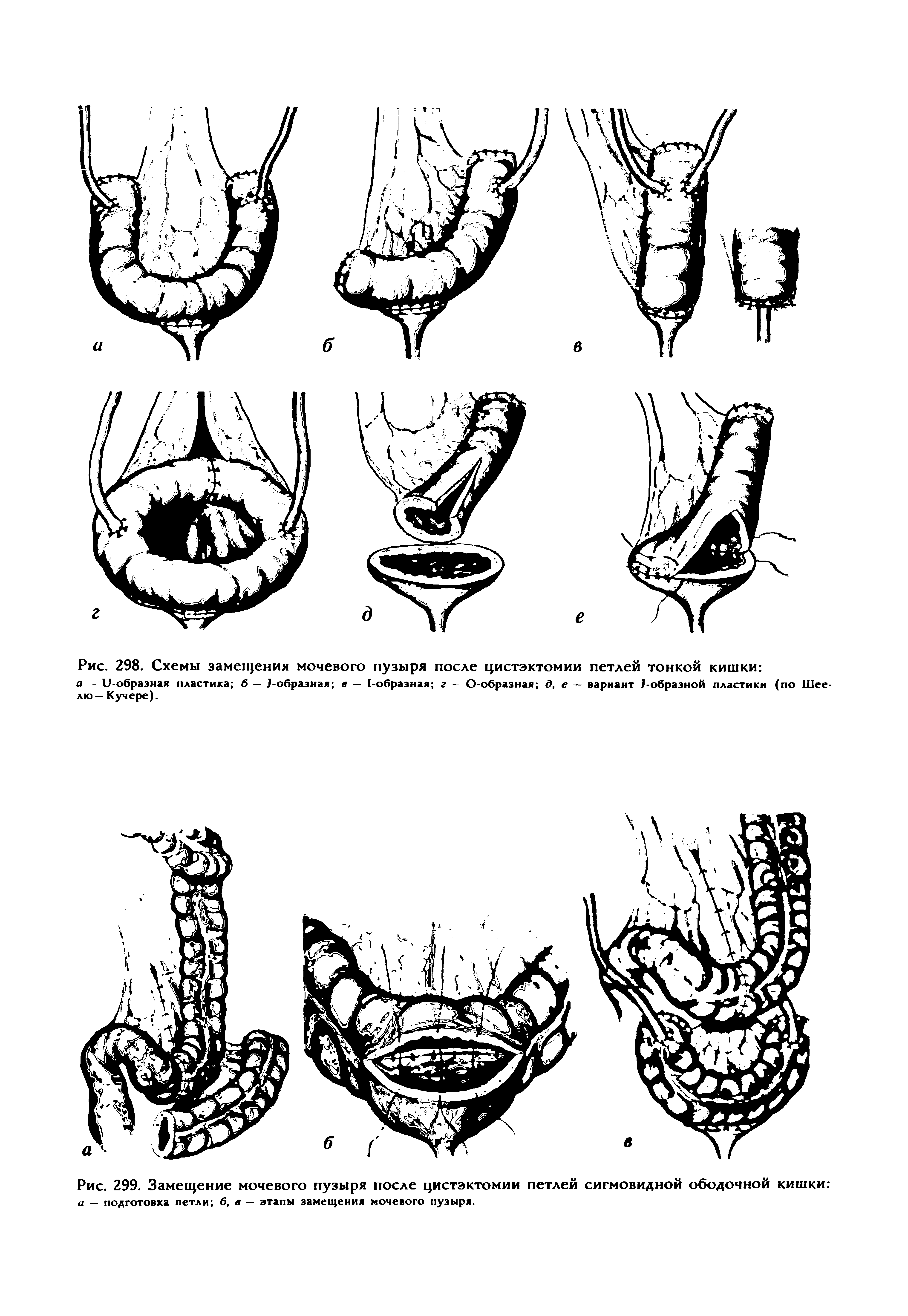 Рис. 299. Замещение мочевого пузыря после цистэктомии петлей сигмовидной ободочной кишки а — подготовка петли 6, в — этапы замещения мочевого пузыря.