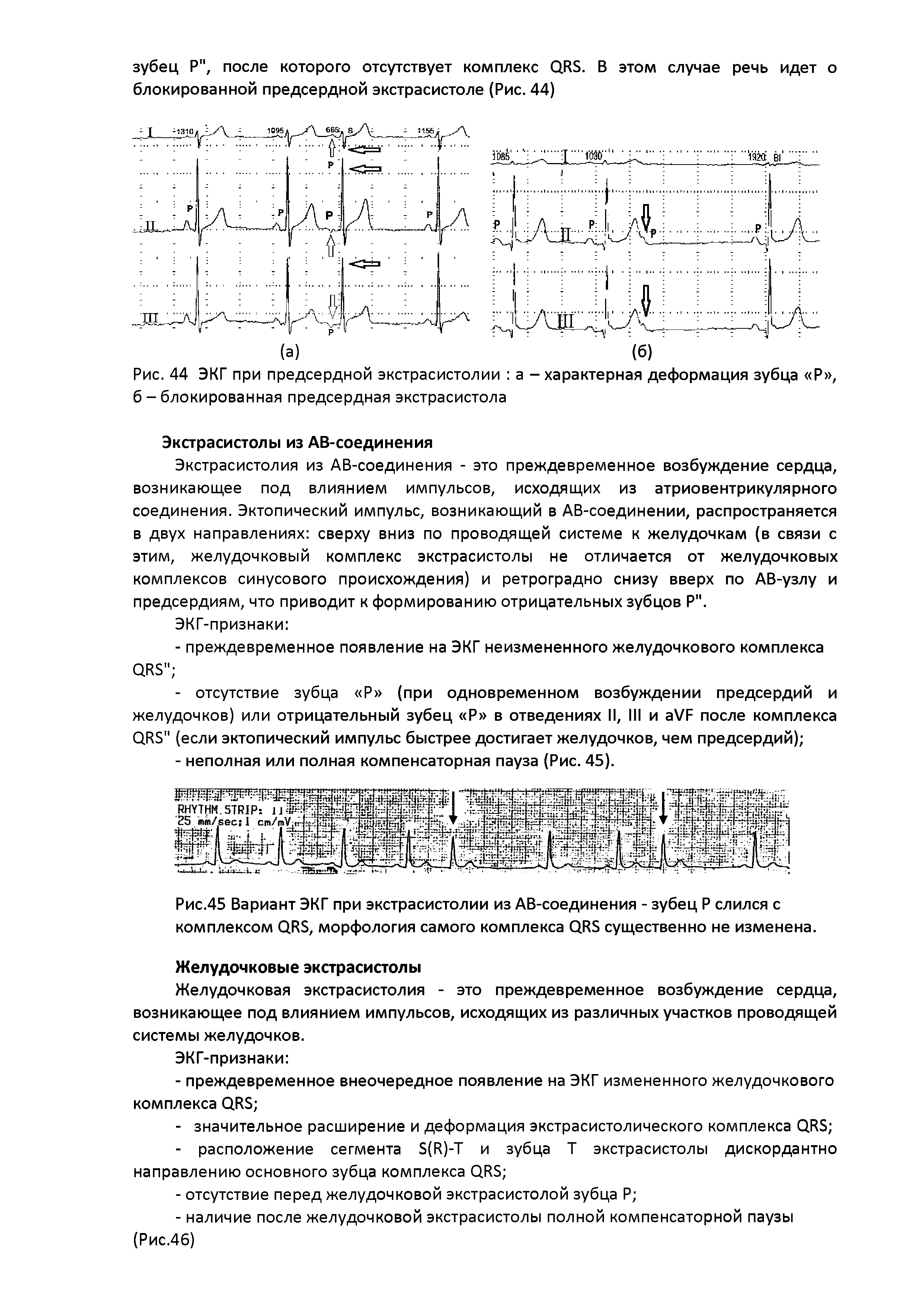 Рис. 44 ЭКГ при предсердной экстрасистолии а - характерная деформация зубца Р , б - блокированная предсердная экстрасистола...