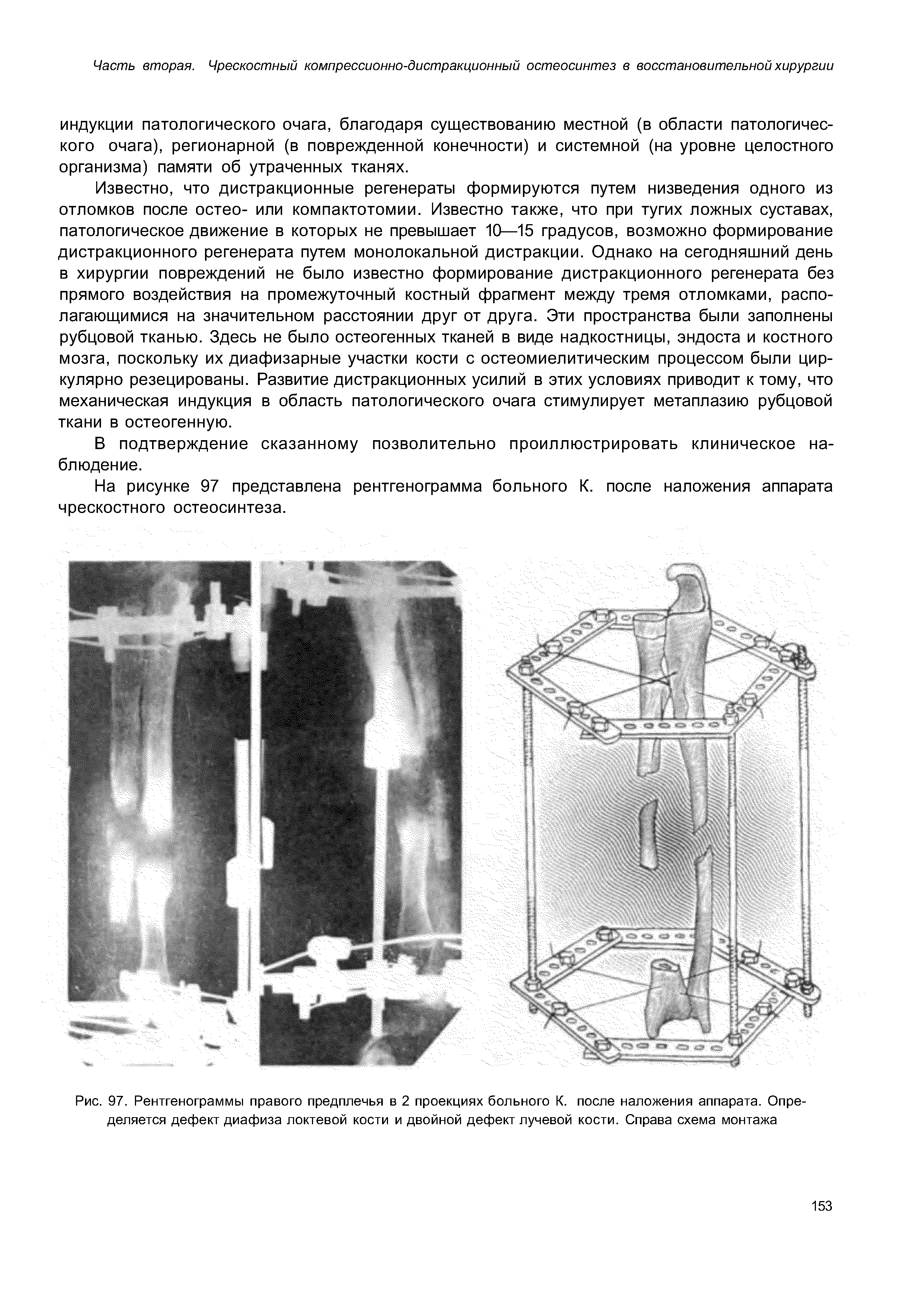 Рис. 97. Рентгенограммы правого предплечья в 2 проекциях больного К. после наложения аппарата. Определяется дефект диафиза локтевой кости и двойной дефект лучевой кости. Справа схема монтажа...
