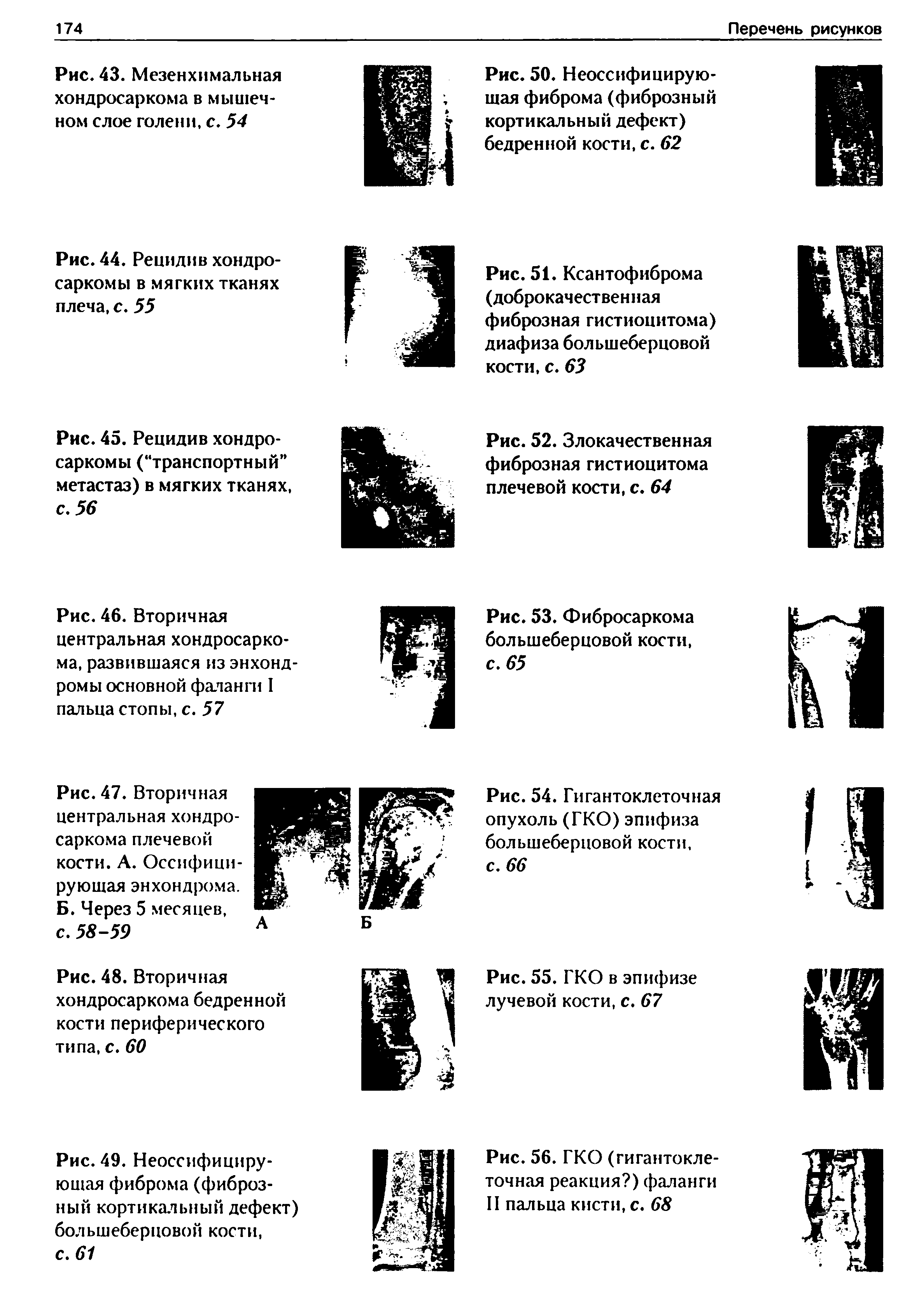 Рис. 49. Неоссифициру-юшая фиброма (фиброзный кортикальный дефект) большеберцовой кости,...