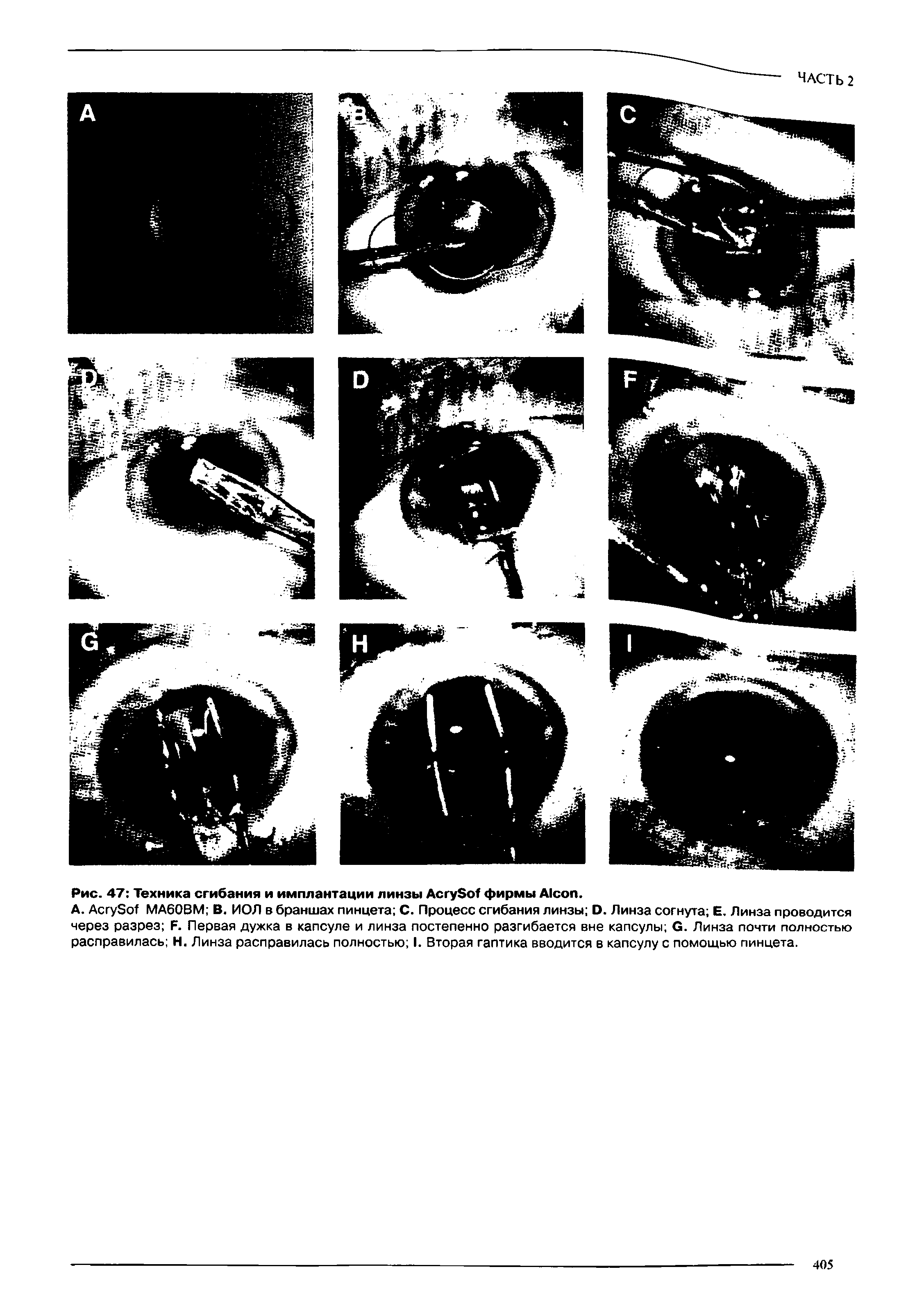 Рис. 47 Техника сгибания и имплантации линзы A S фирмы A .