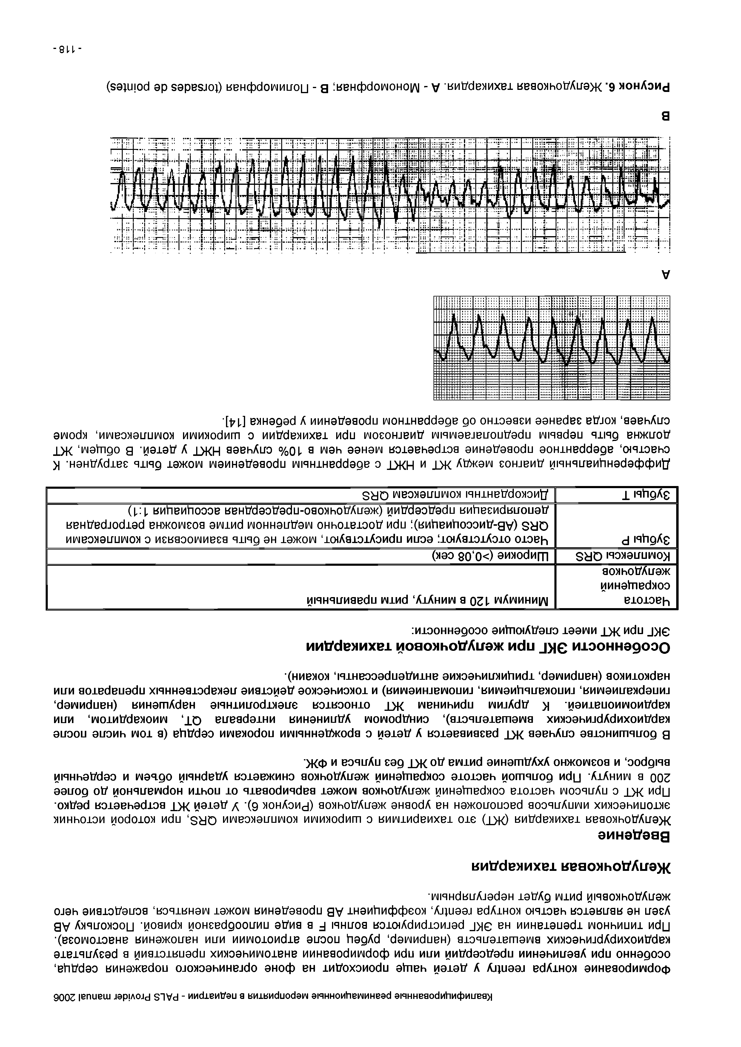 Рисунок 6. Желудочковая тахикардия. А - Мономорфная В - Полиморфная ( )...