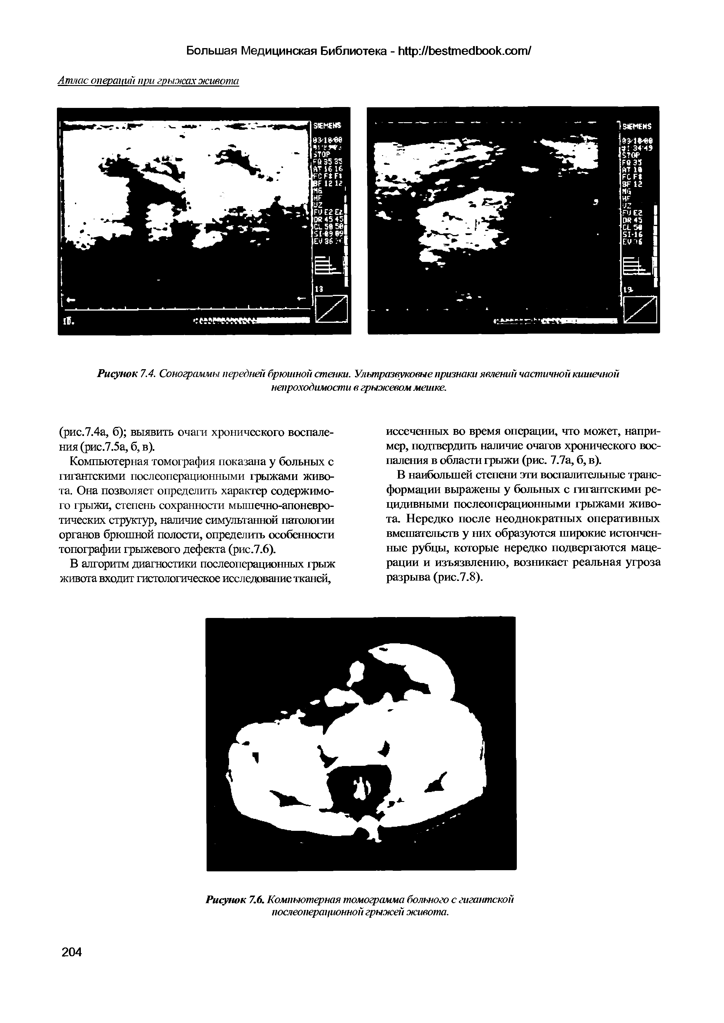 Рисунок 7.6. Компьютерная томограмма больного с гигантской послеоперационной грыжей живота.