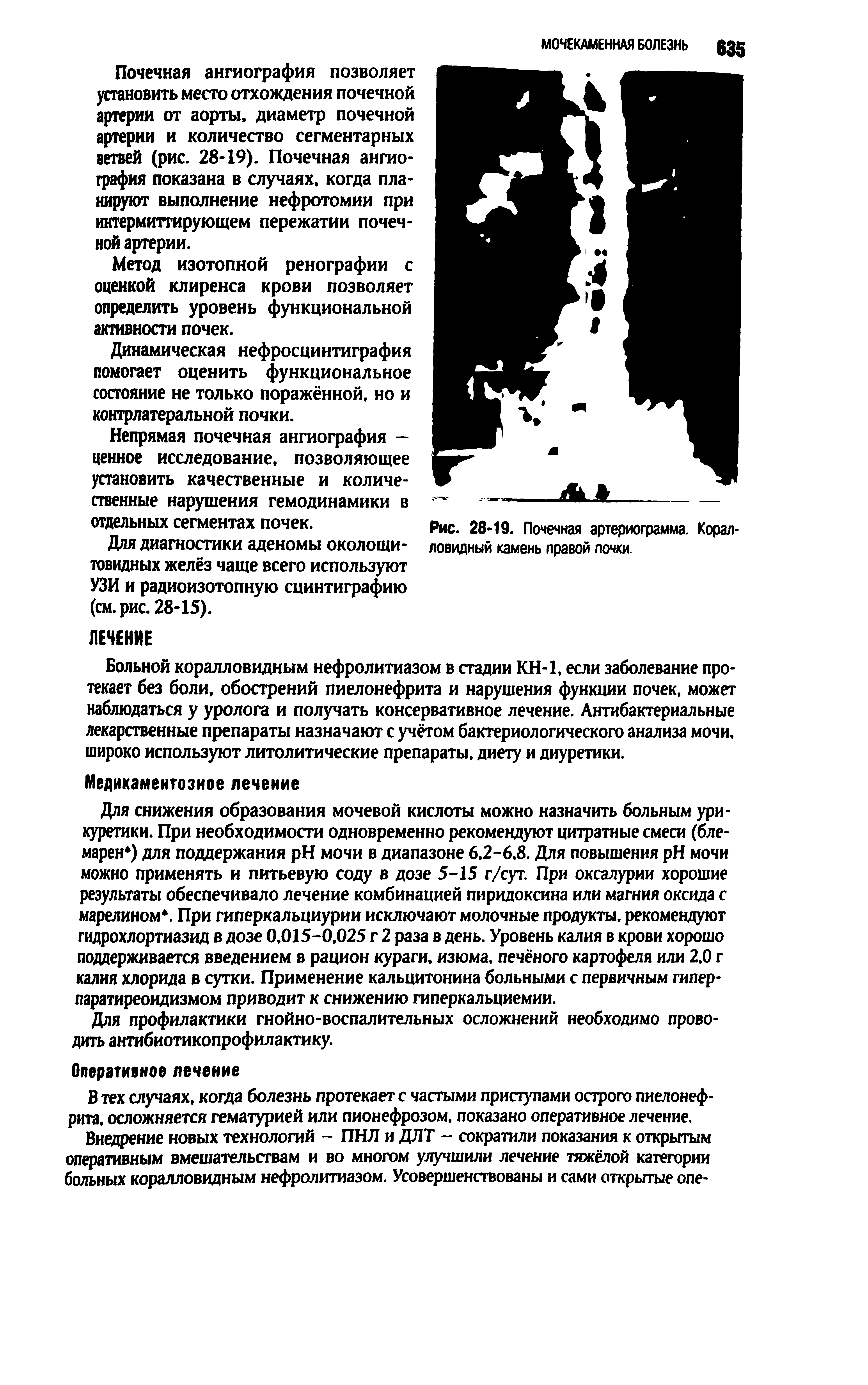 Рис. 28-19. Почечная артериограмма. Коралловидный камень правой почки...