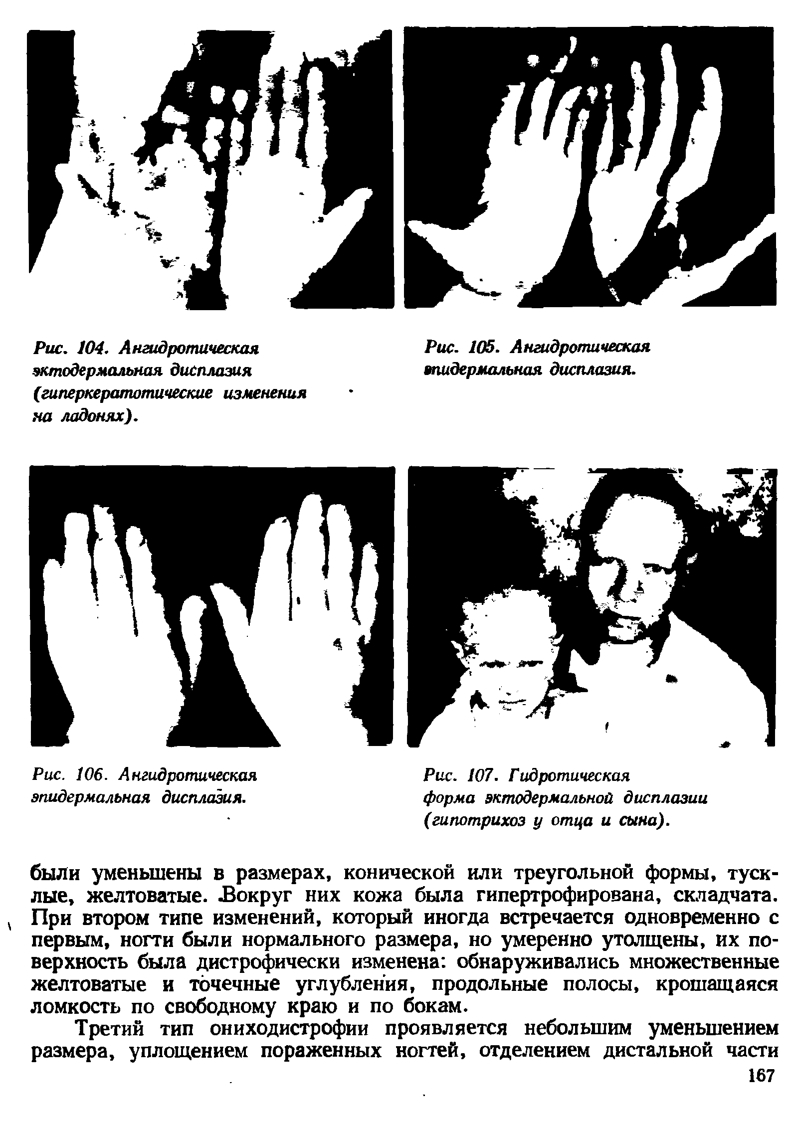 Рис. 104. Ангидротическая эктодермальная дисплазия (гиперкератотические изменения на ладонях).