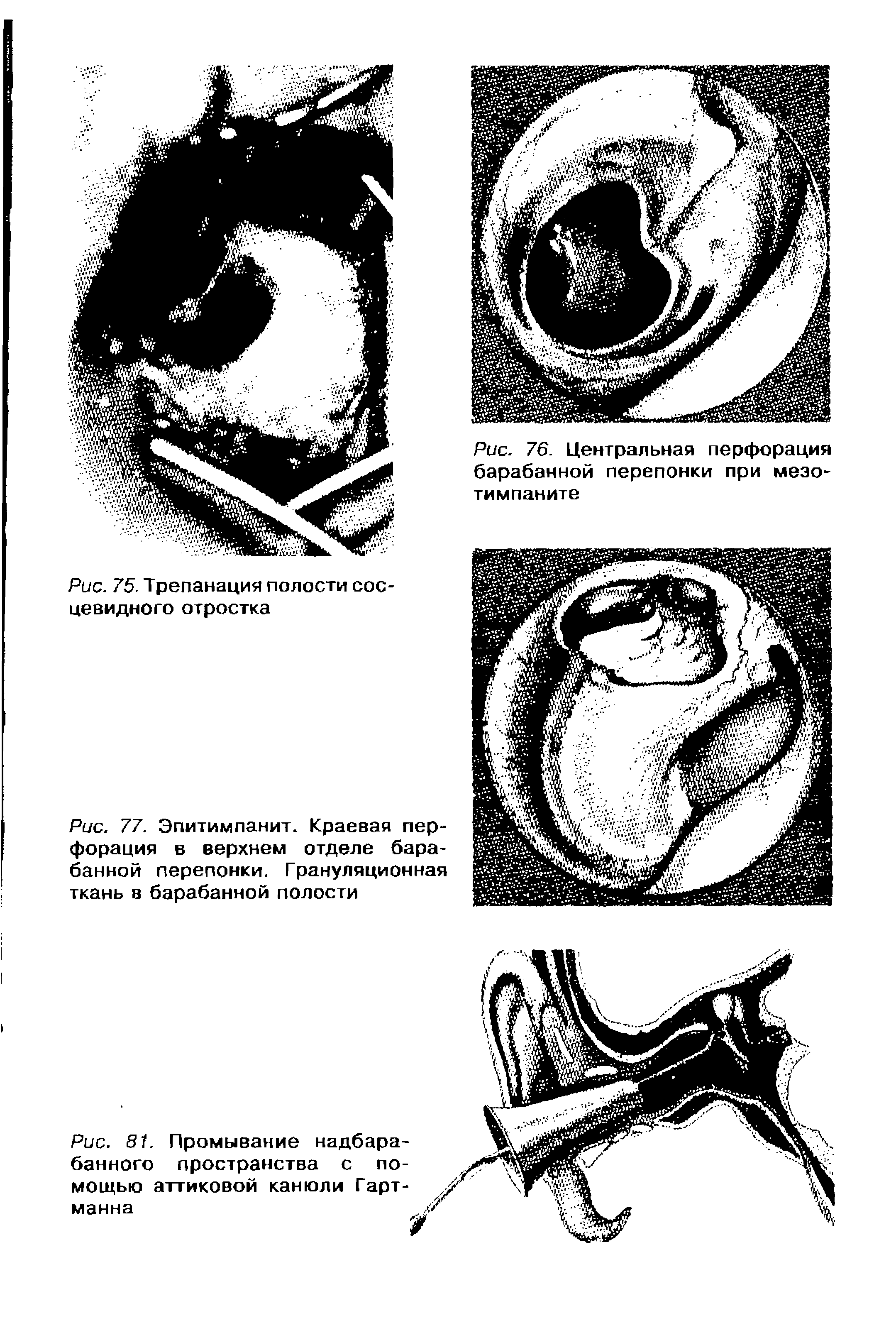 Рис. 81. Промывание надбарабанного пространства с помощью аттиковой канюли Гарт-манна...