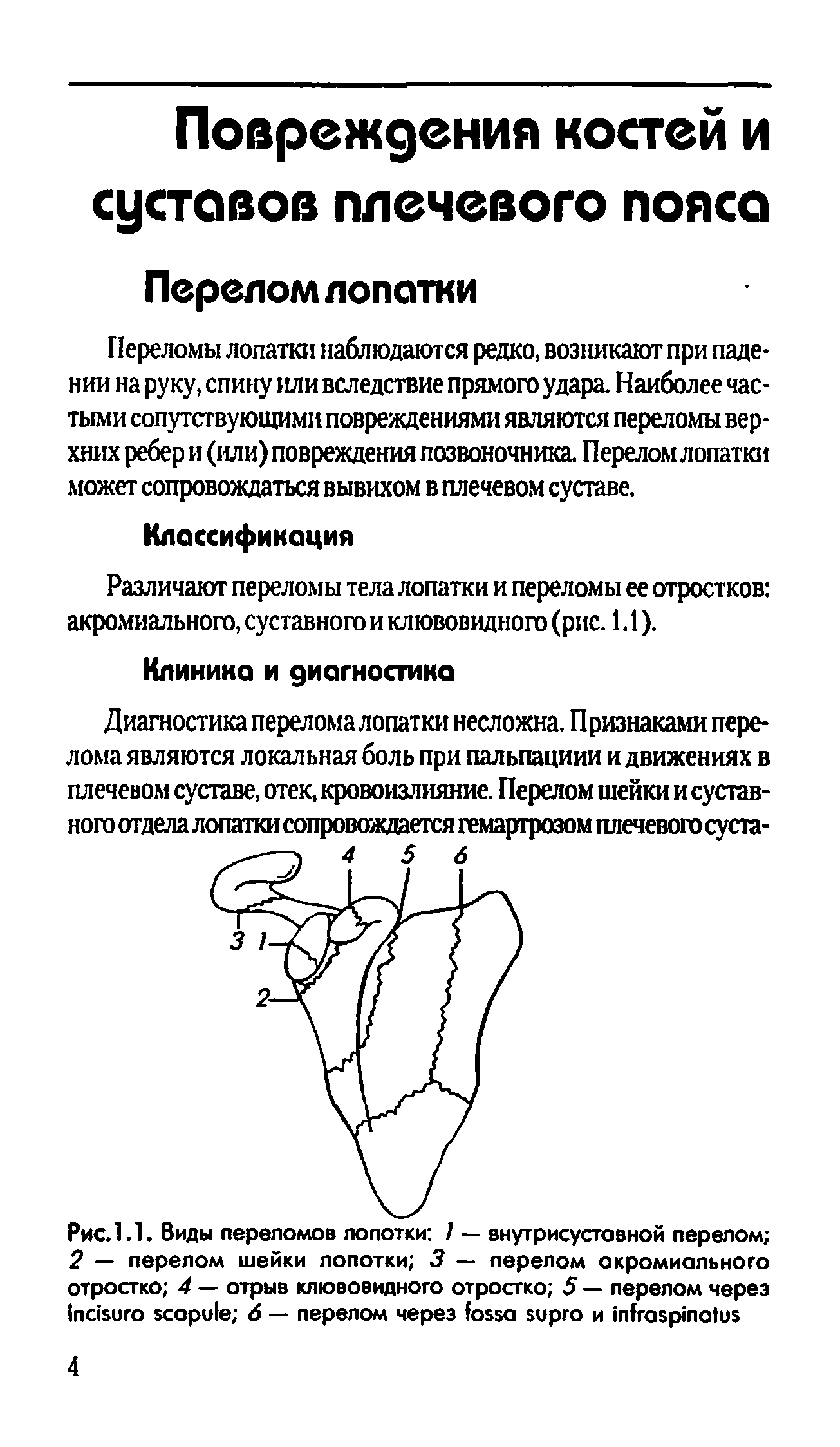 Рис.1.1. Виды переломов лопотки 1 — внутрисуставной перелом 2 — перелом шейки лопотки 3 — перелом акромиального отростко 4 — отрыв клювовидного отростко 5 — перелом через I 6 — перелом через и ...