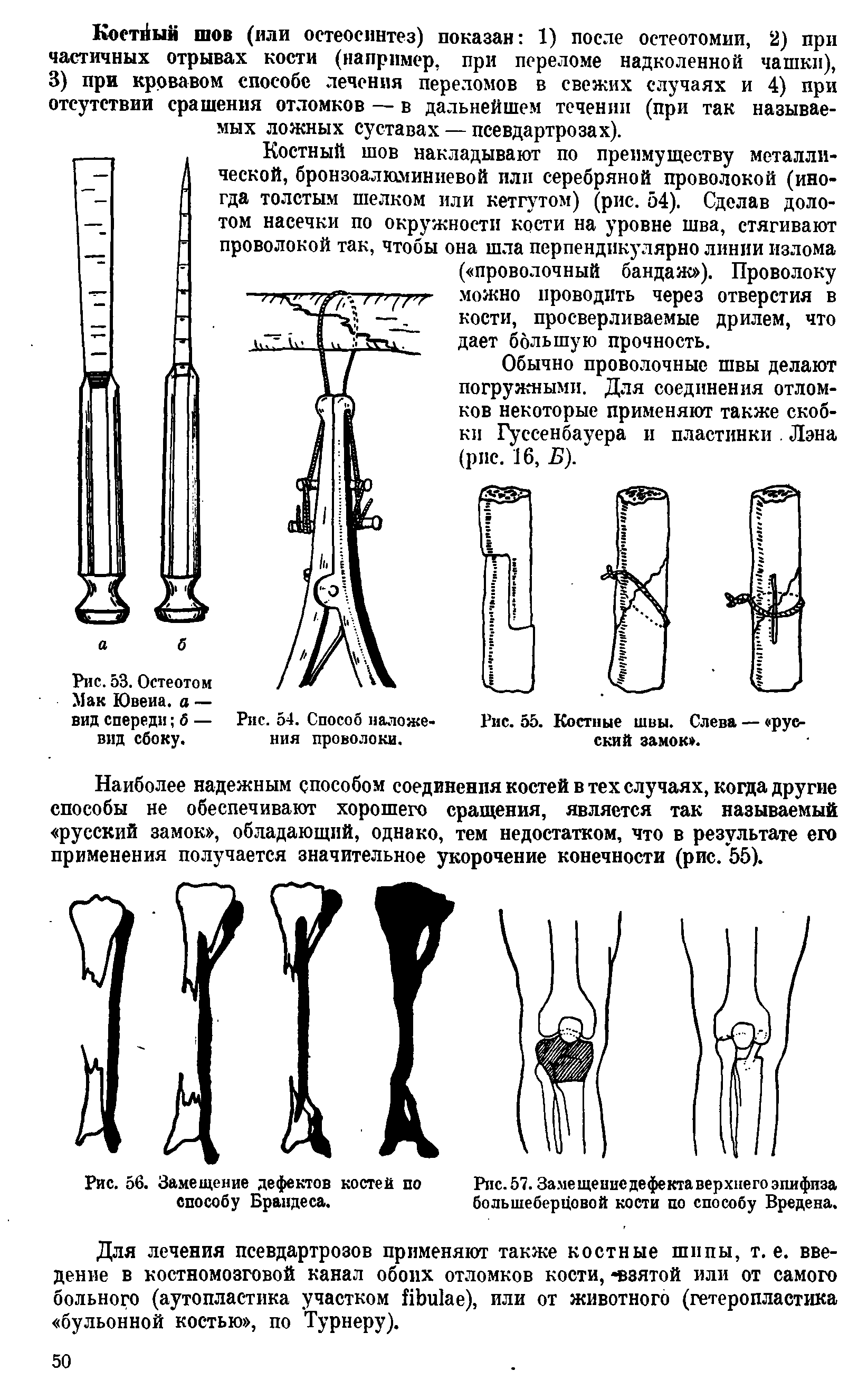 Рис. 56. Замещение дефектов костей по Рис.57.Замещепиедефектаверхнегоэпифиза способу Брандеса. большеберцовой кости по способу Вредена.