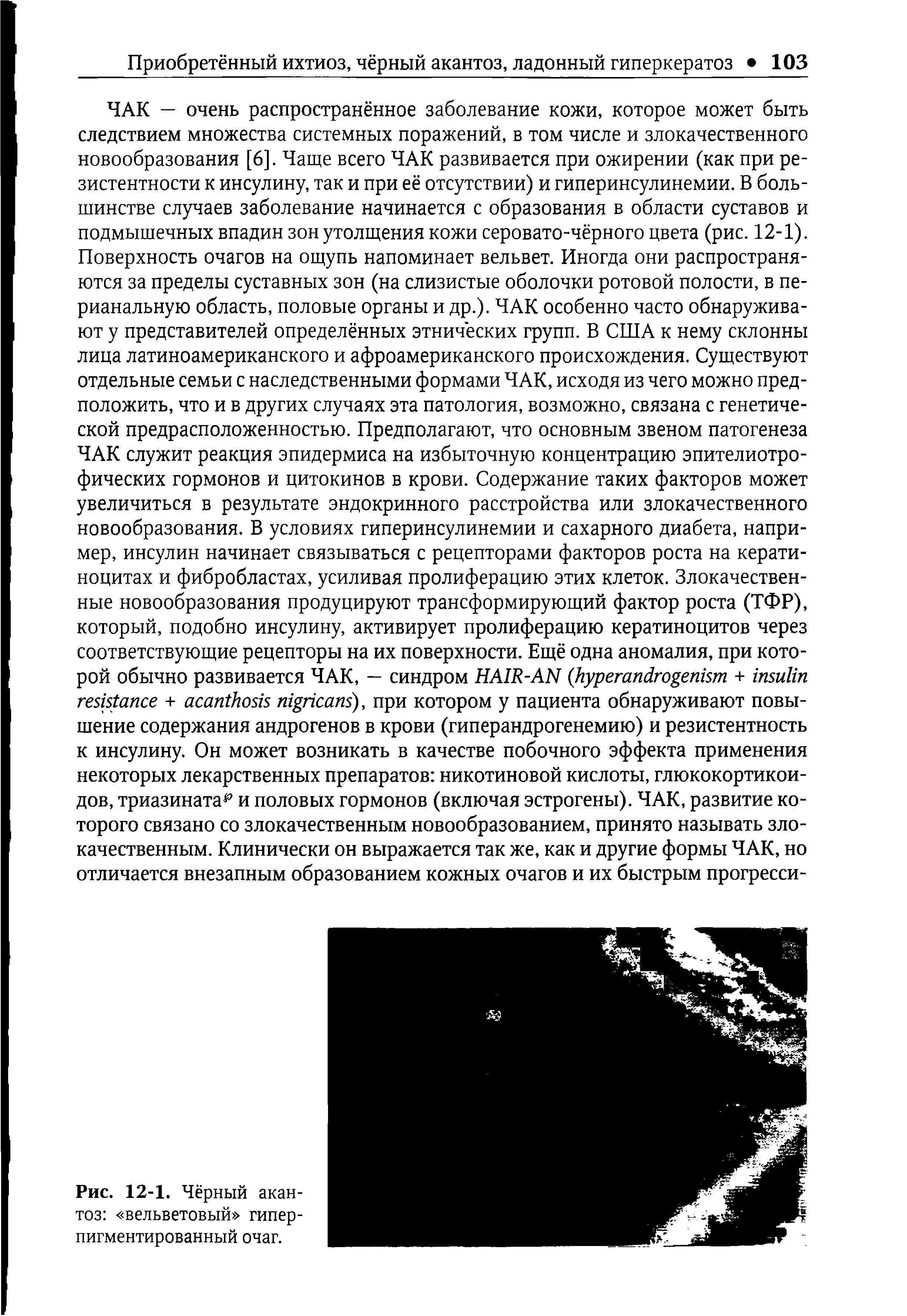 Рис. 12-1. Чёрный акантоз вельветовый гипер-пигментированный очаг.