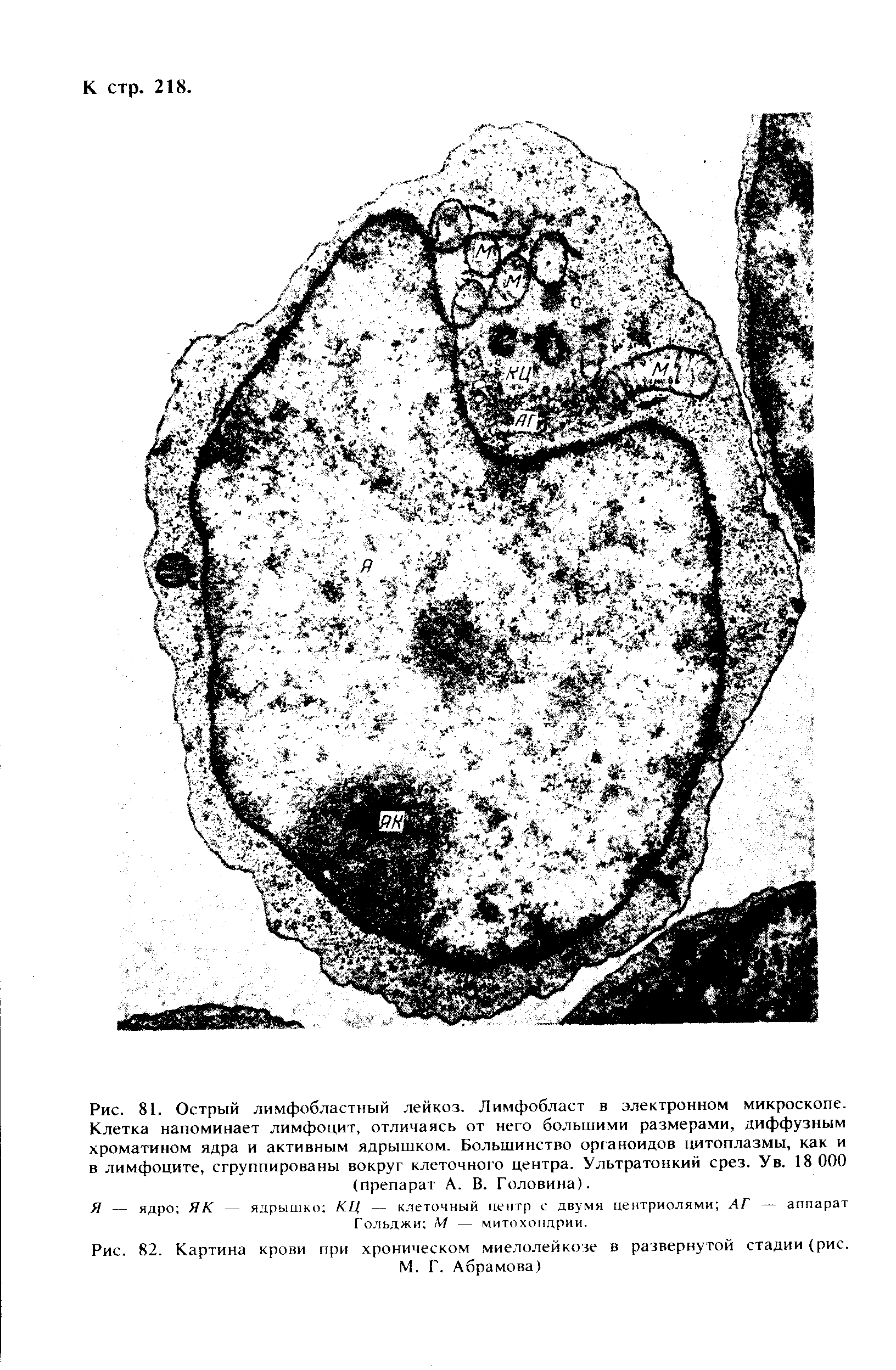 Рис. 81. Острый лимфобластный лейкоз. Лимфобласт в электронном микроскопе. Клетка напоминает лимфоцит, отличаясь от него большими размерами, диффузным хроматином ядра и активным ядрышком. Большинство органоидов цитоплазмы, как и в лимфоците, сгруппированы вокруг клеточного центра. Ультратонкий срез. У в. 18 000 (препарат А. В. Головина).