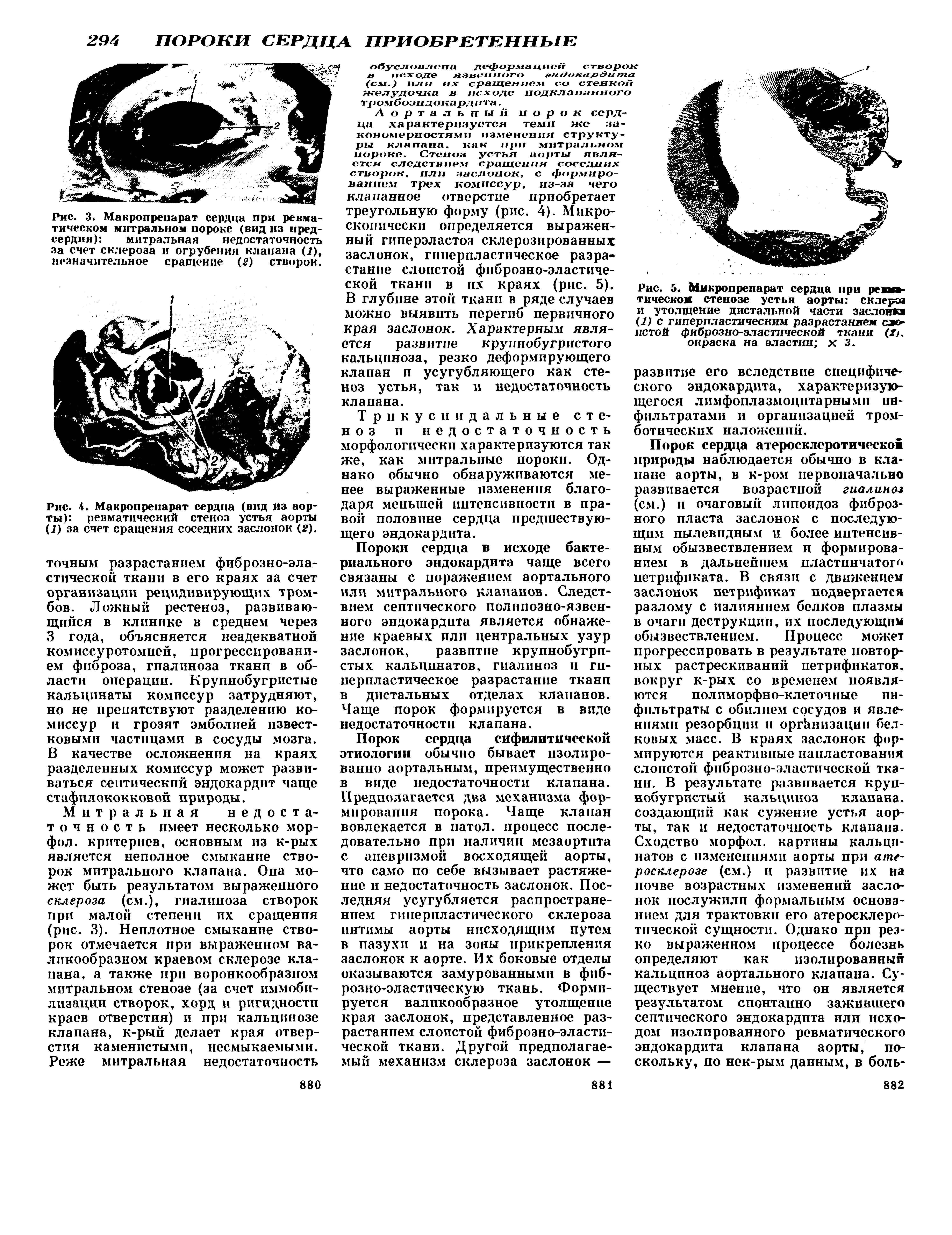 Рис. 3. Макропрепарат сердца при ревматическом митральном пороке (вид из предсердия) митральная недостаточность...