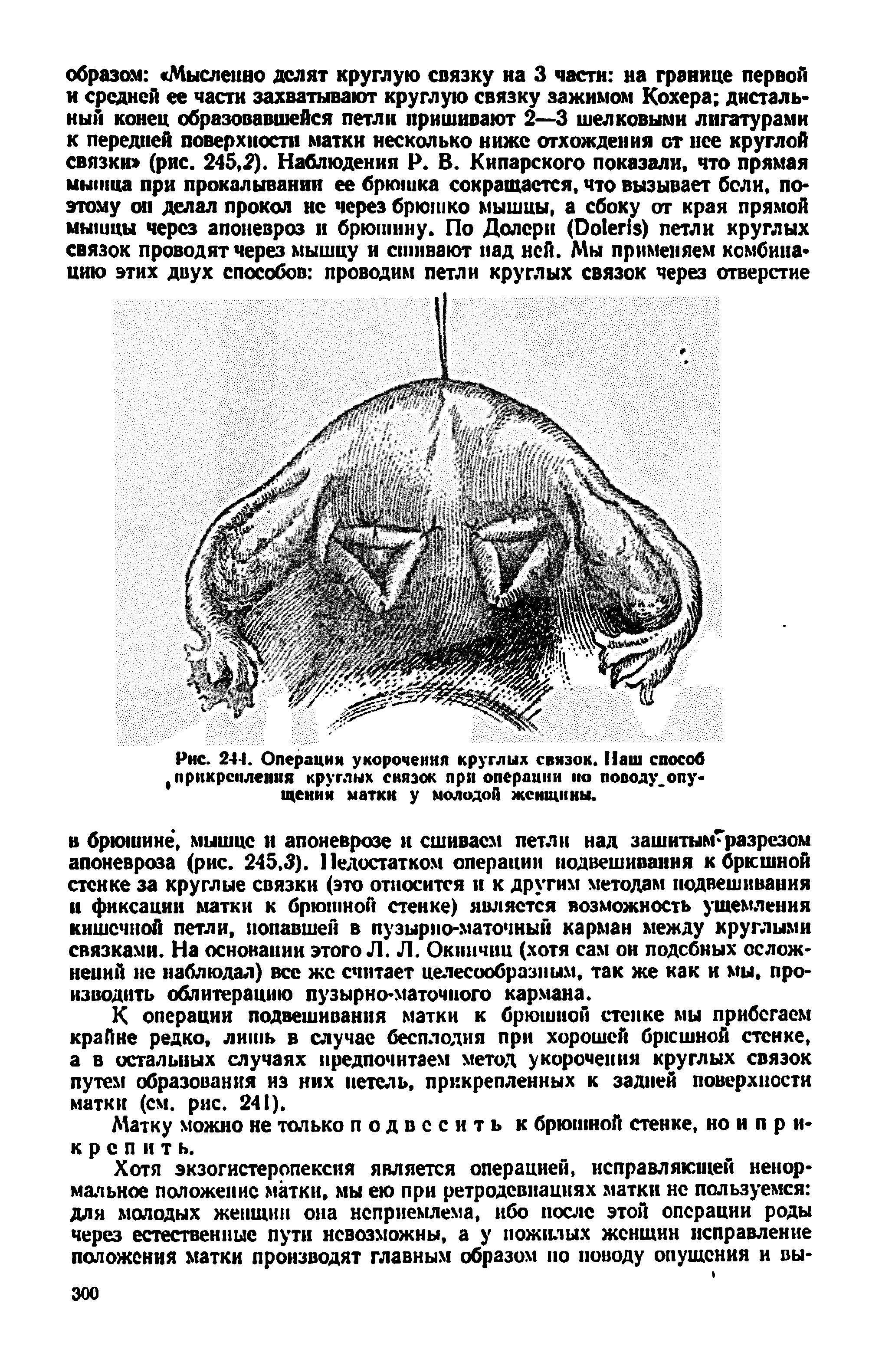 Рис. 241. Операции укорочения круглых связок. Наш способ Прикрепления круглых связок при операции ио поводу.опущения матки у молодой женщины.