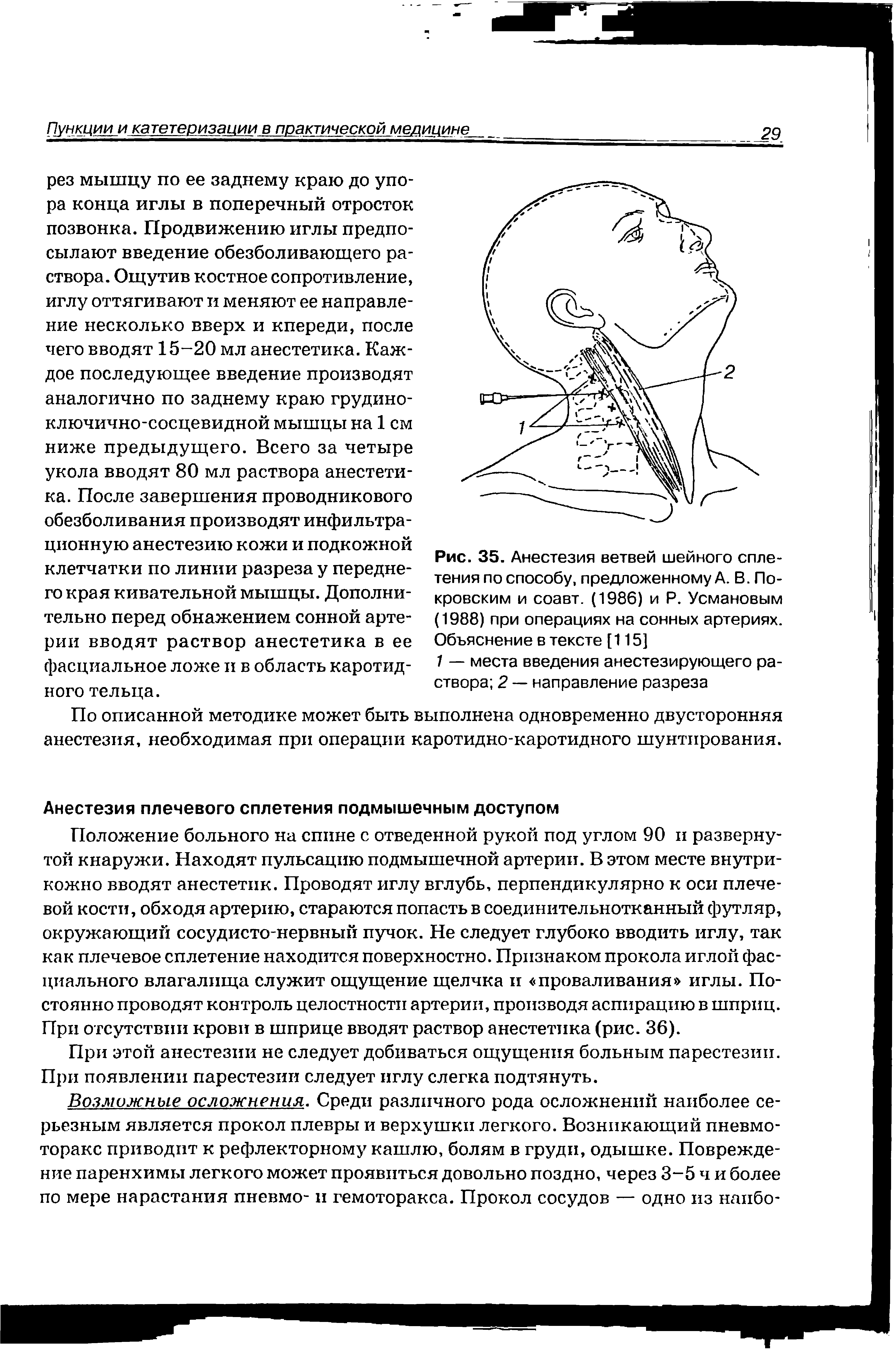 Рис. 35. Анестезия ветвей шейного сплетения по способу, предложенному А. В. Покровским и соавт. (1986) и Р. Усмановым (1988) при операциях на сонных артериях. Объяснение в тексте [115]...