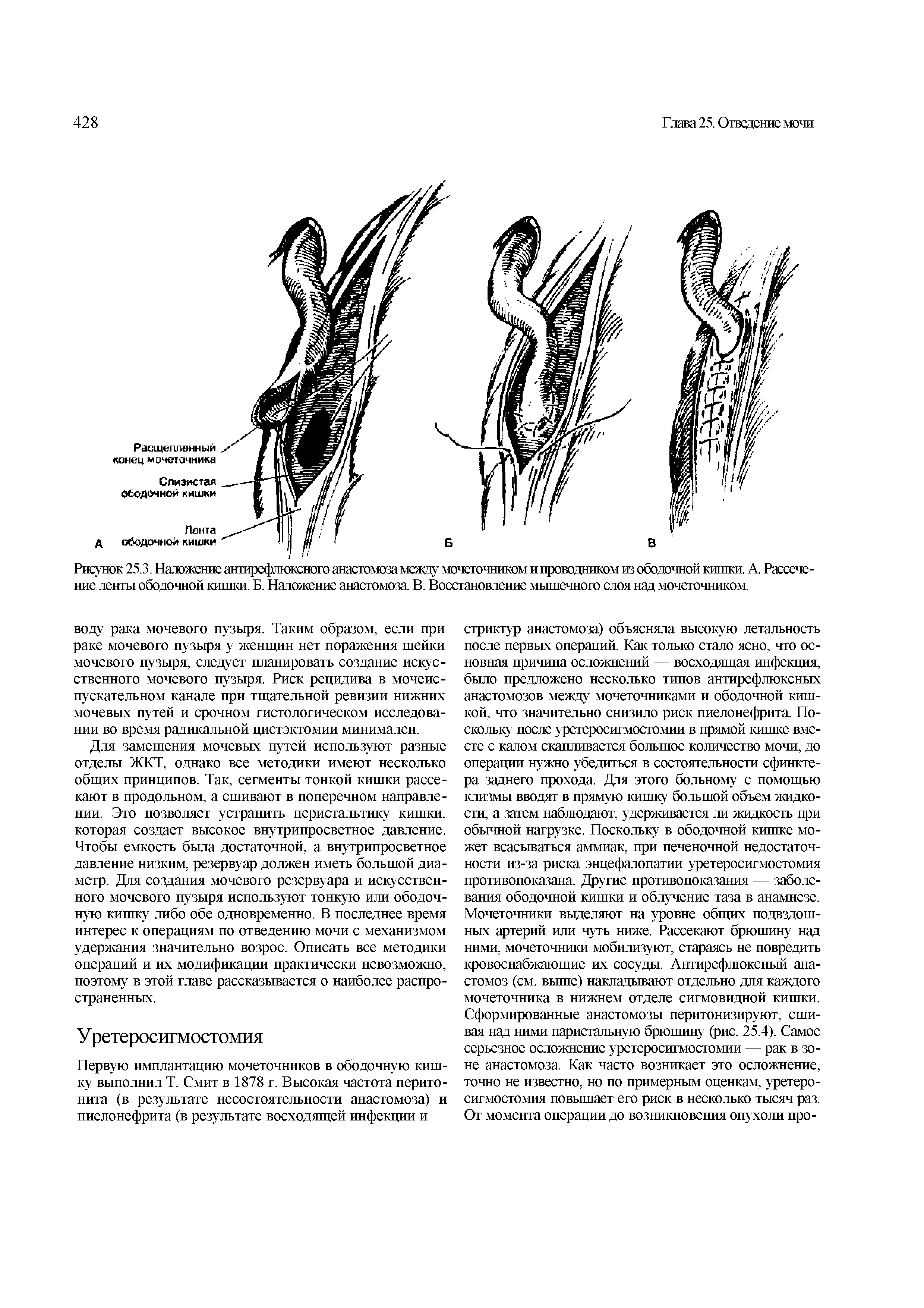 Рисунок 25.3. Наложение антирефлюксного анастомоза мецду мочеточником и проводником из ободочной кишки. А. Рассечение ленты ободочной кишки. Б. Наложение анастомоза В. Восстановление мышечного слоя над мочеточником.