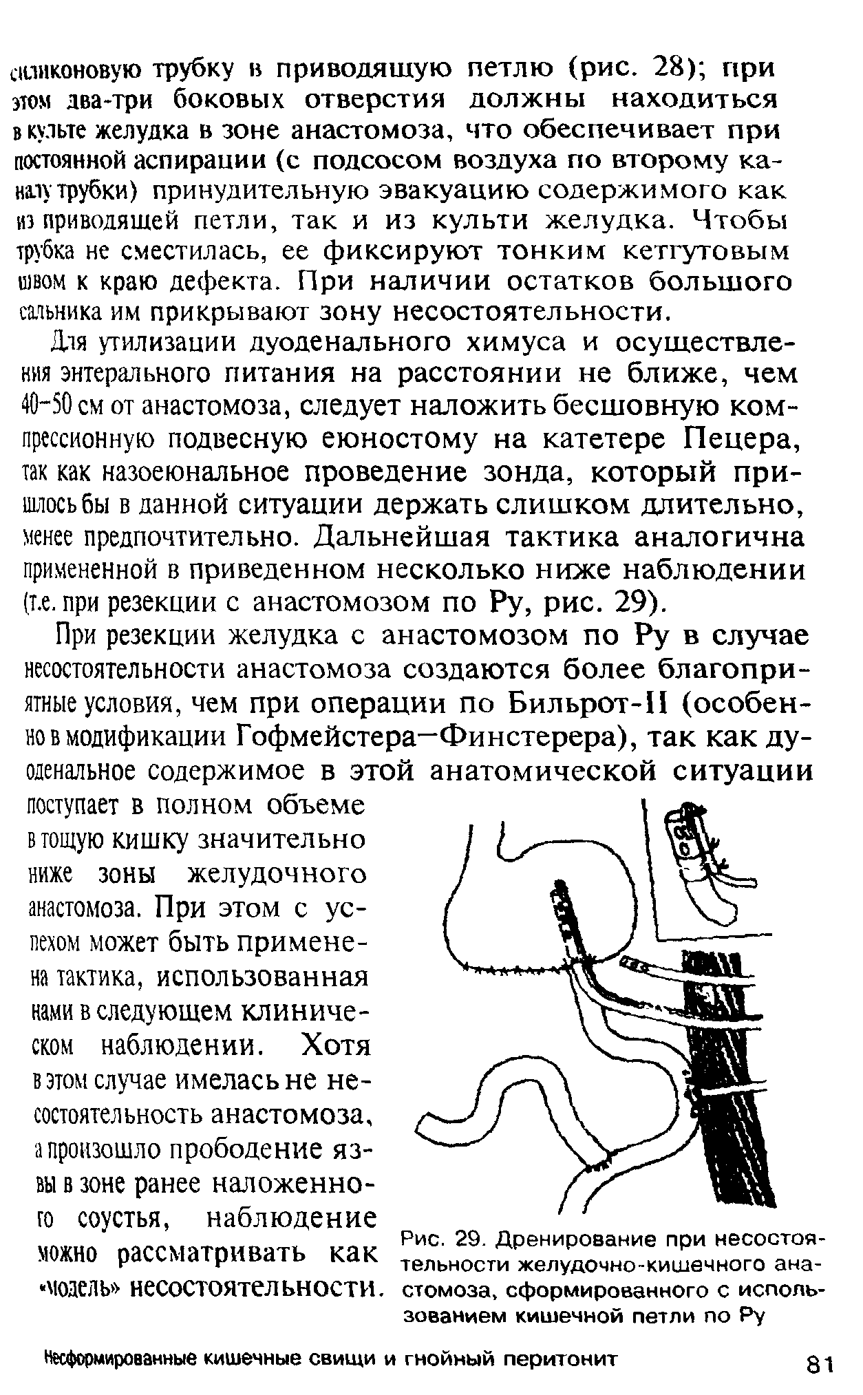 Рис. 29. Дренирование при несостоятельности желудочно-кишечного анастомоза, сформированного с использованием кишечной петли по Ру...