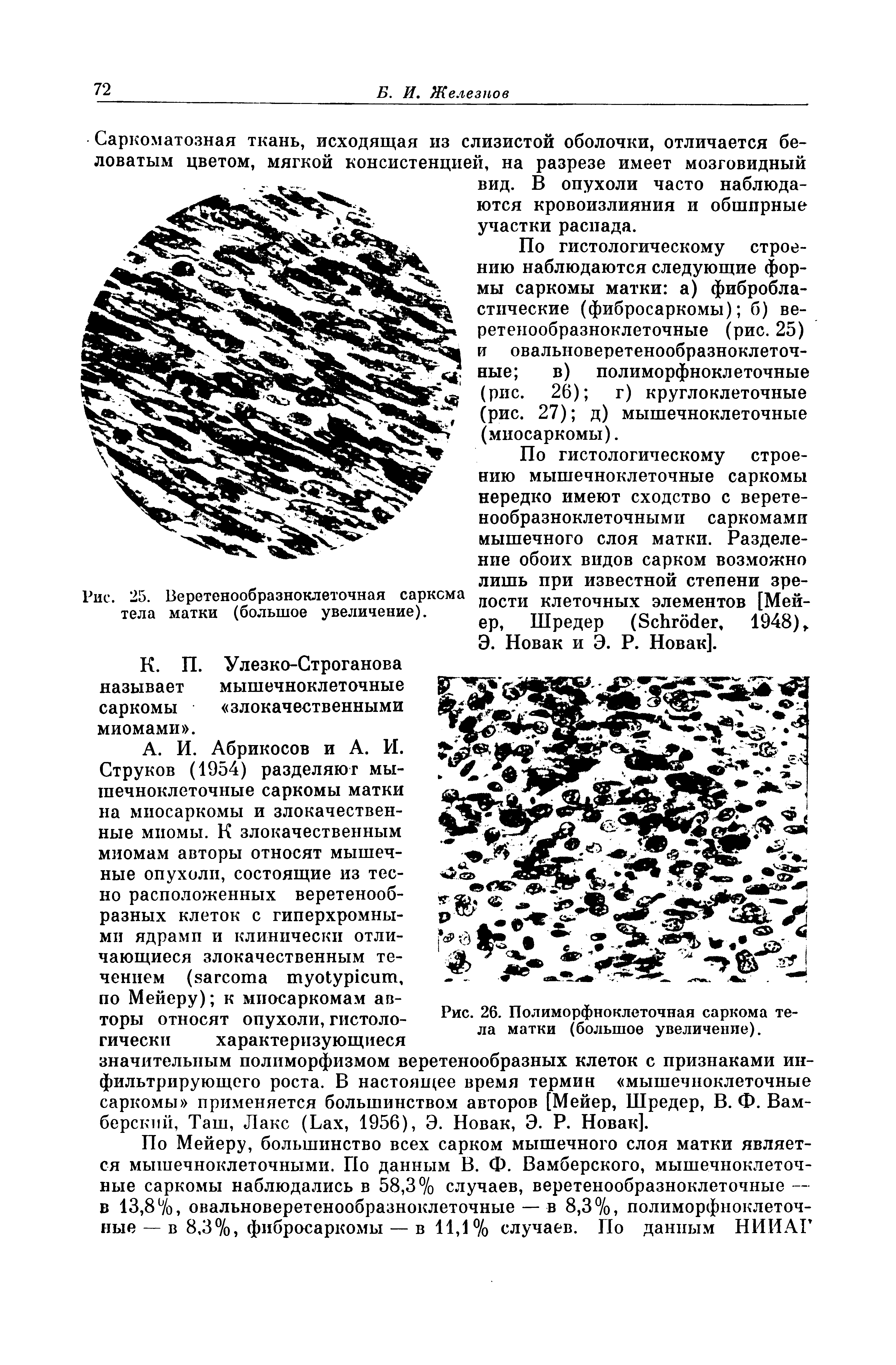 Рис. 26. Полиморфноклеточная саркома тела матки (большое увеличение).