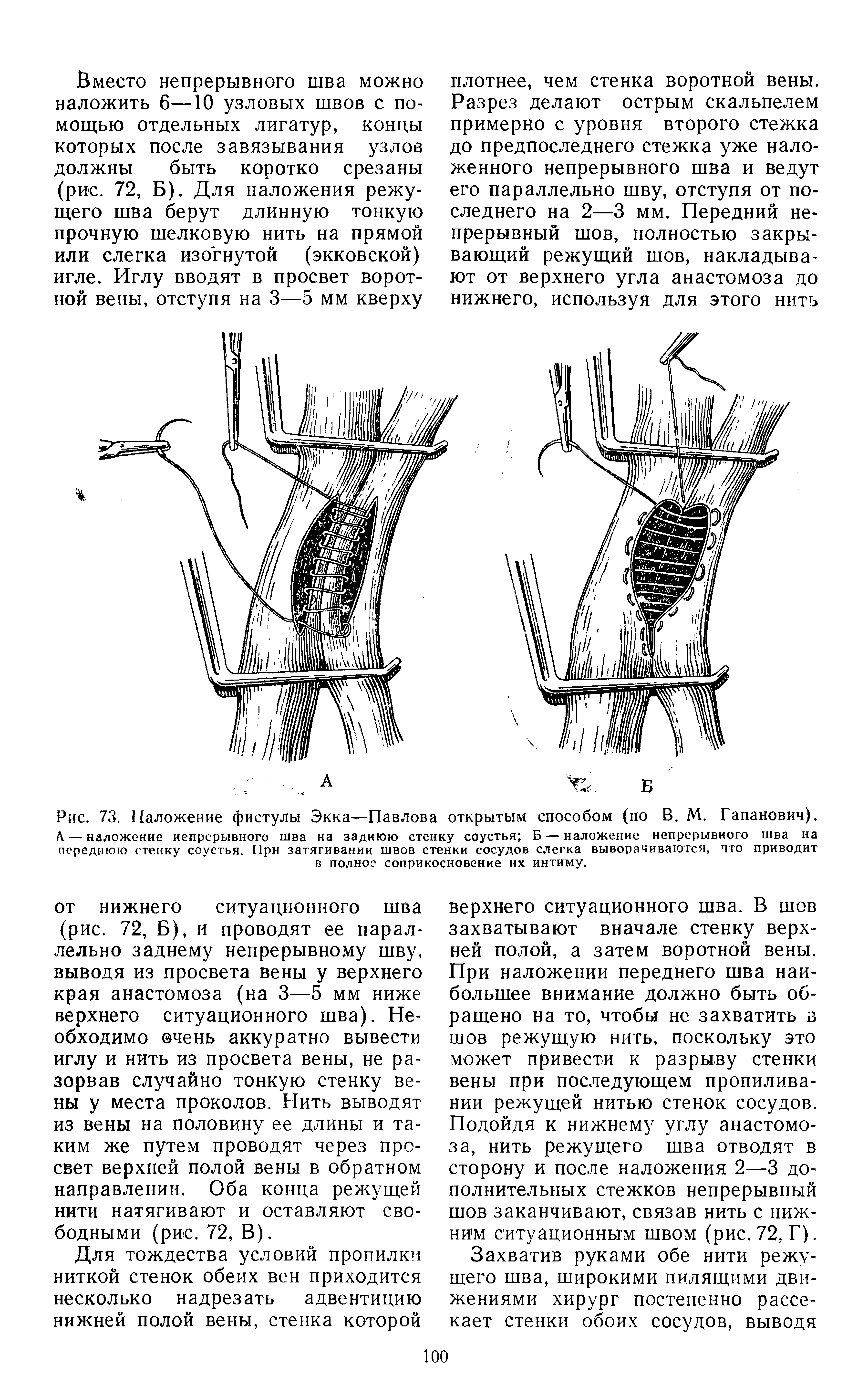 Рис. 73. Наложение фистулы Экка—Павлова открытым способом (по В. М. Гапанович).