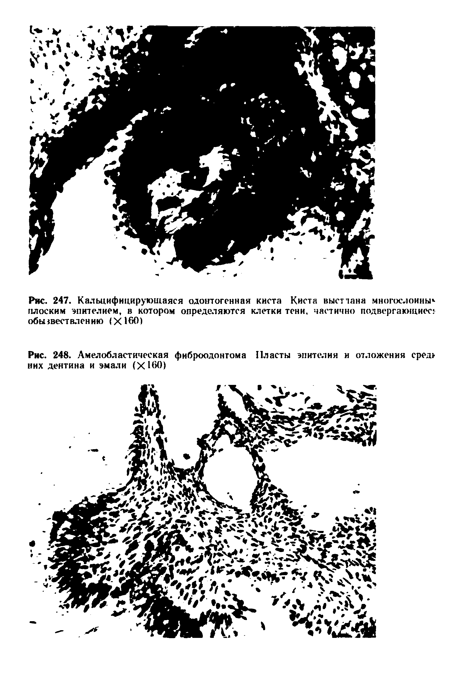 Рис. 248. Амелобластическая фиброодонтома Пласты эпителия и отложения сред них дентина и эмали (X160)...