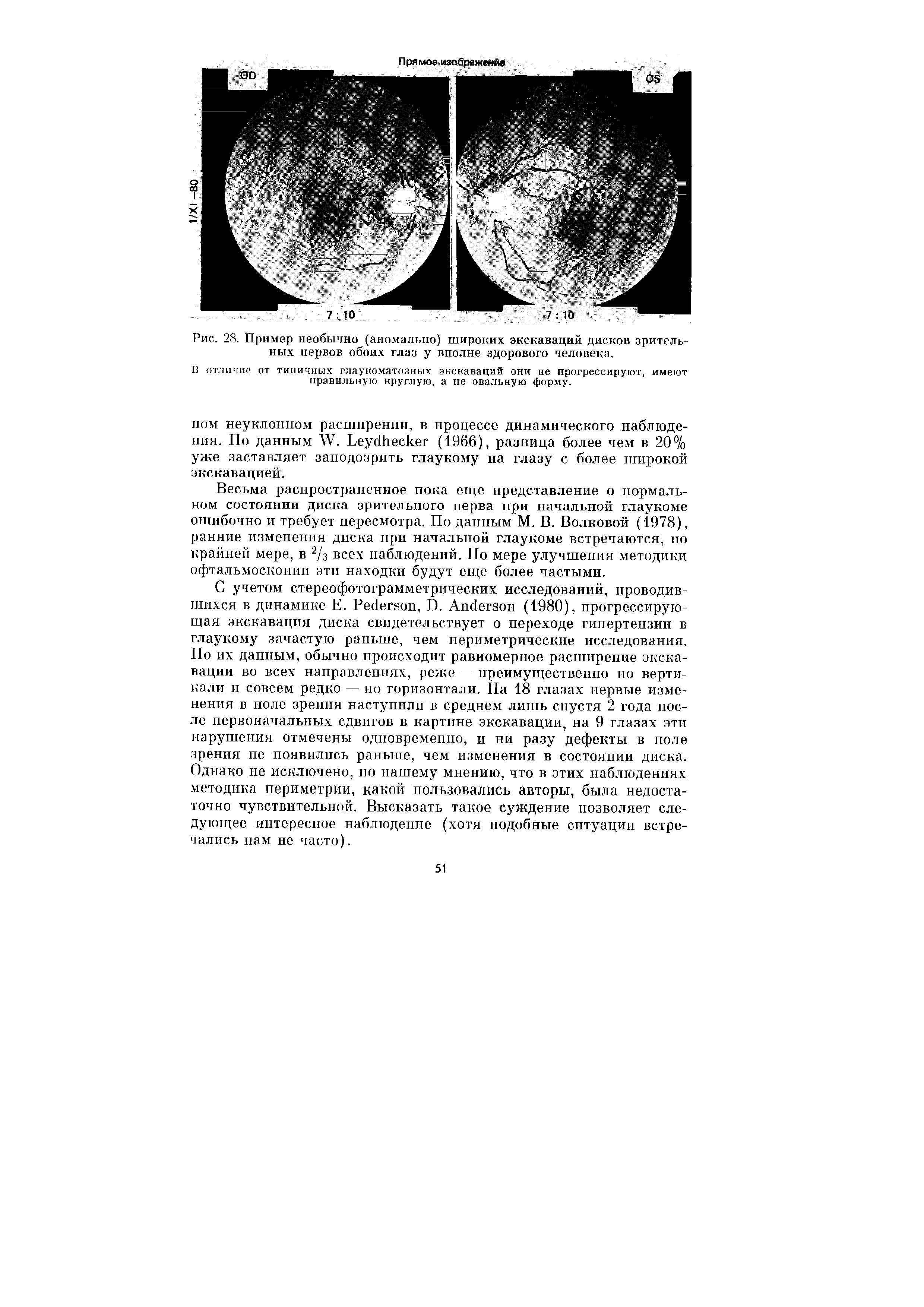 Рис. 28. Пример необычно (аномально) широких экскаваций дисков зрительных нервов обоих глаз у вполне здорового человека.