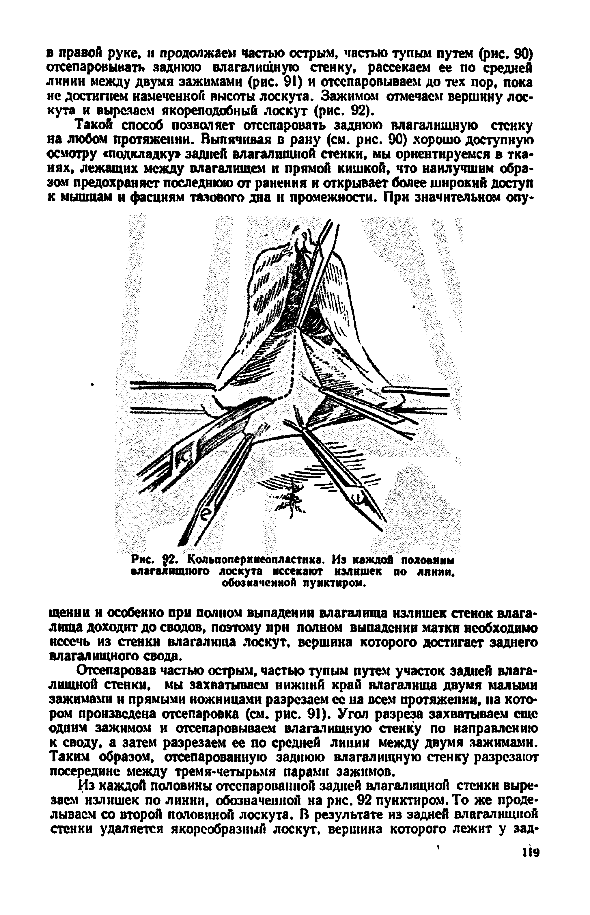 Рис. 2. Кольпоперинеопластика. Иэ каждой половины влагалищного лоскута иссекают излишек по линии, обозначенной пунктиром.