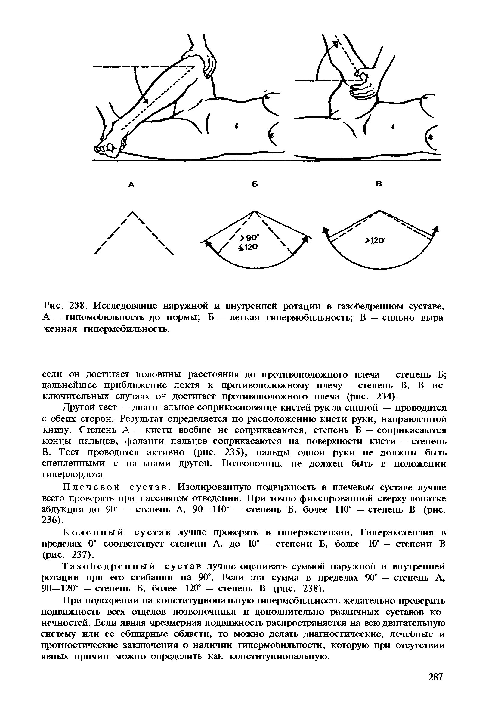 Рис. 238. Исследование наружной и внутренней ротации в газобедренном суставе. А — гипомобильность до нормы Б — легкая гипермобильность В — сильно выра женная гипермобильность.