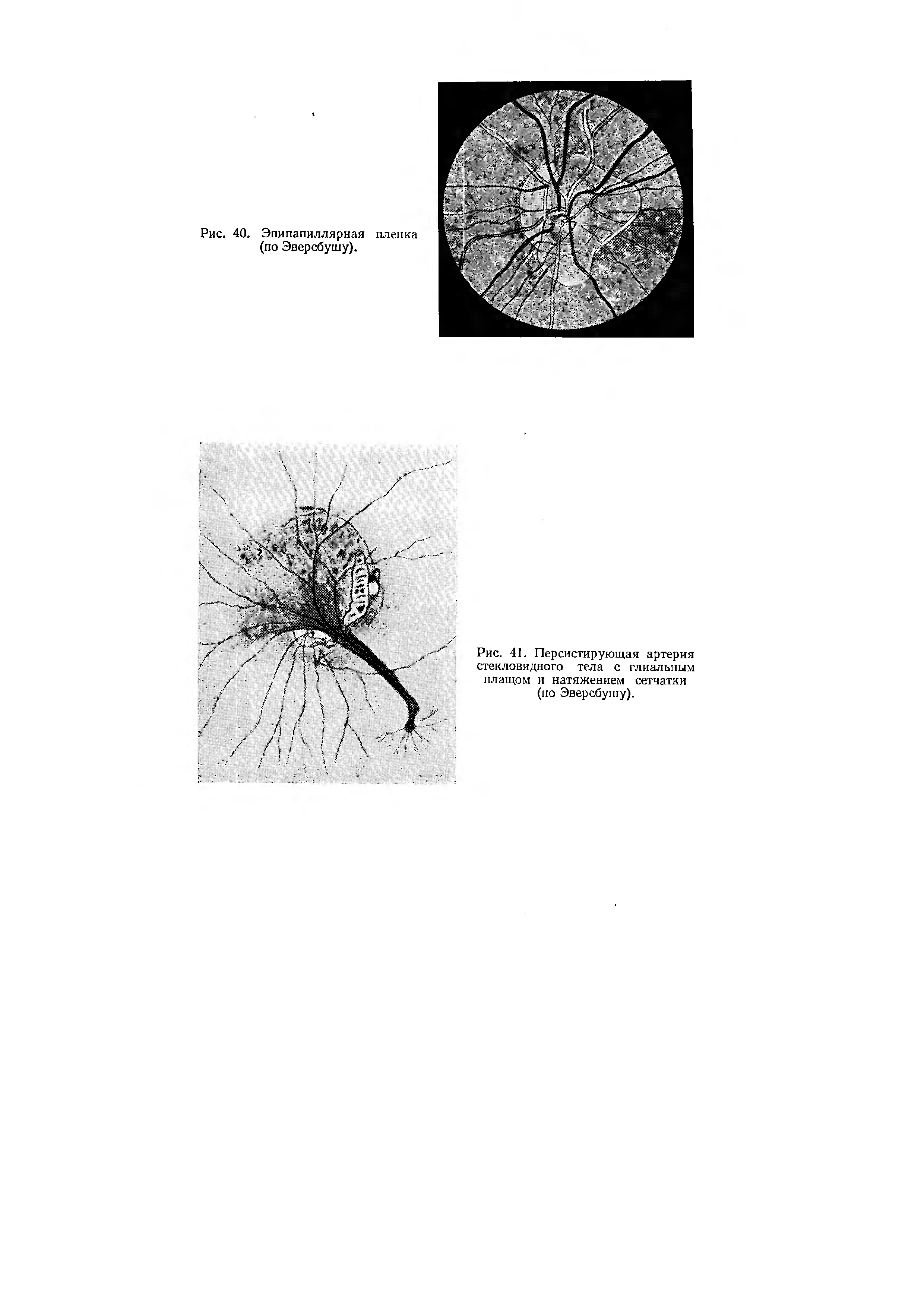 Рис. 41. Персистирующая артерия стекловидного тела с глиальным плащом и натяжением сетчатки (по Эверсбушу).