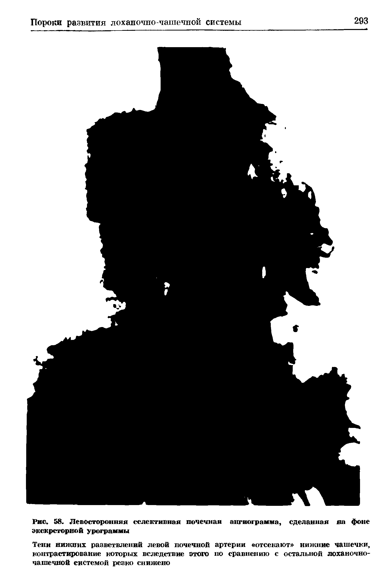 Рис. 58. Левосторонняя селективная почечная ангиограмма, сделанная на фоне экскреторной урограммы...