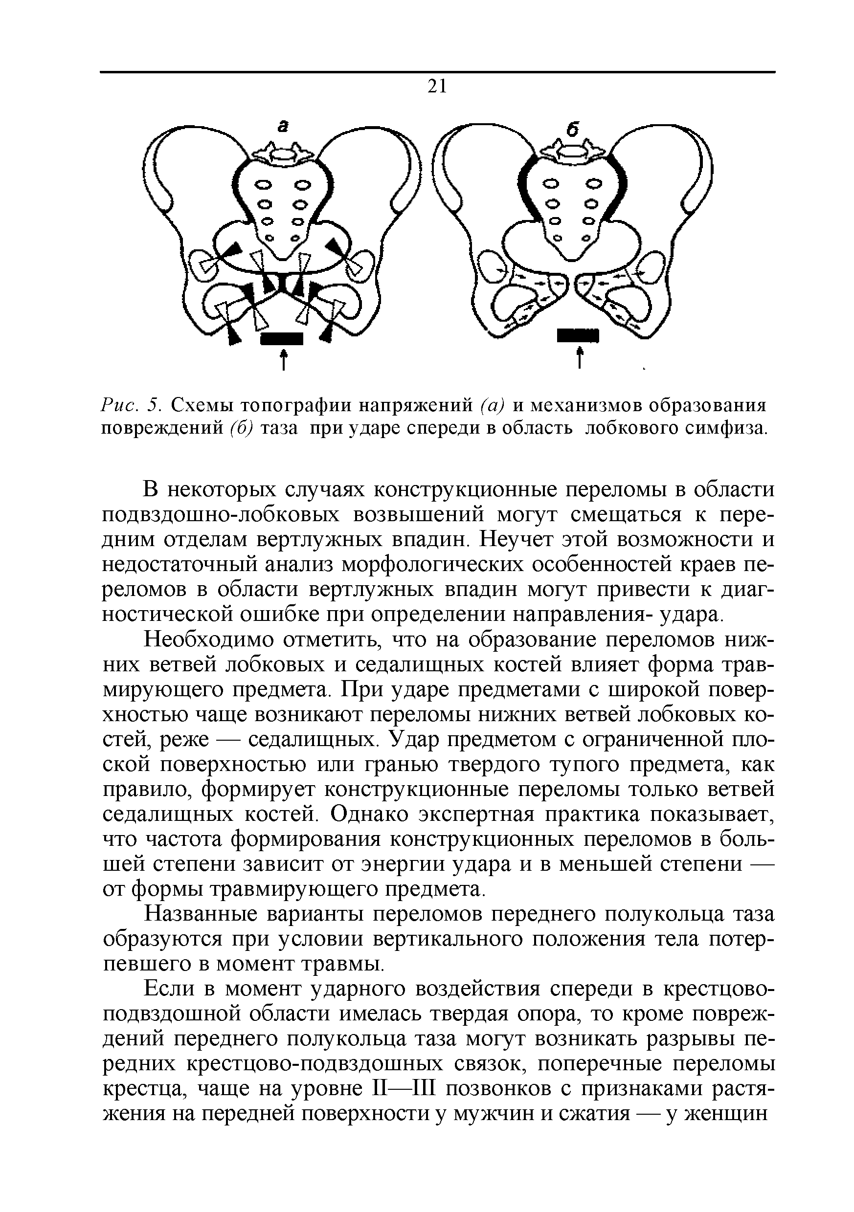 Рис. 5. Схемы топографии напряжений (а) и механизмов образования повреждений (б) таза при ударе спереди в область лобкового симфиза.