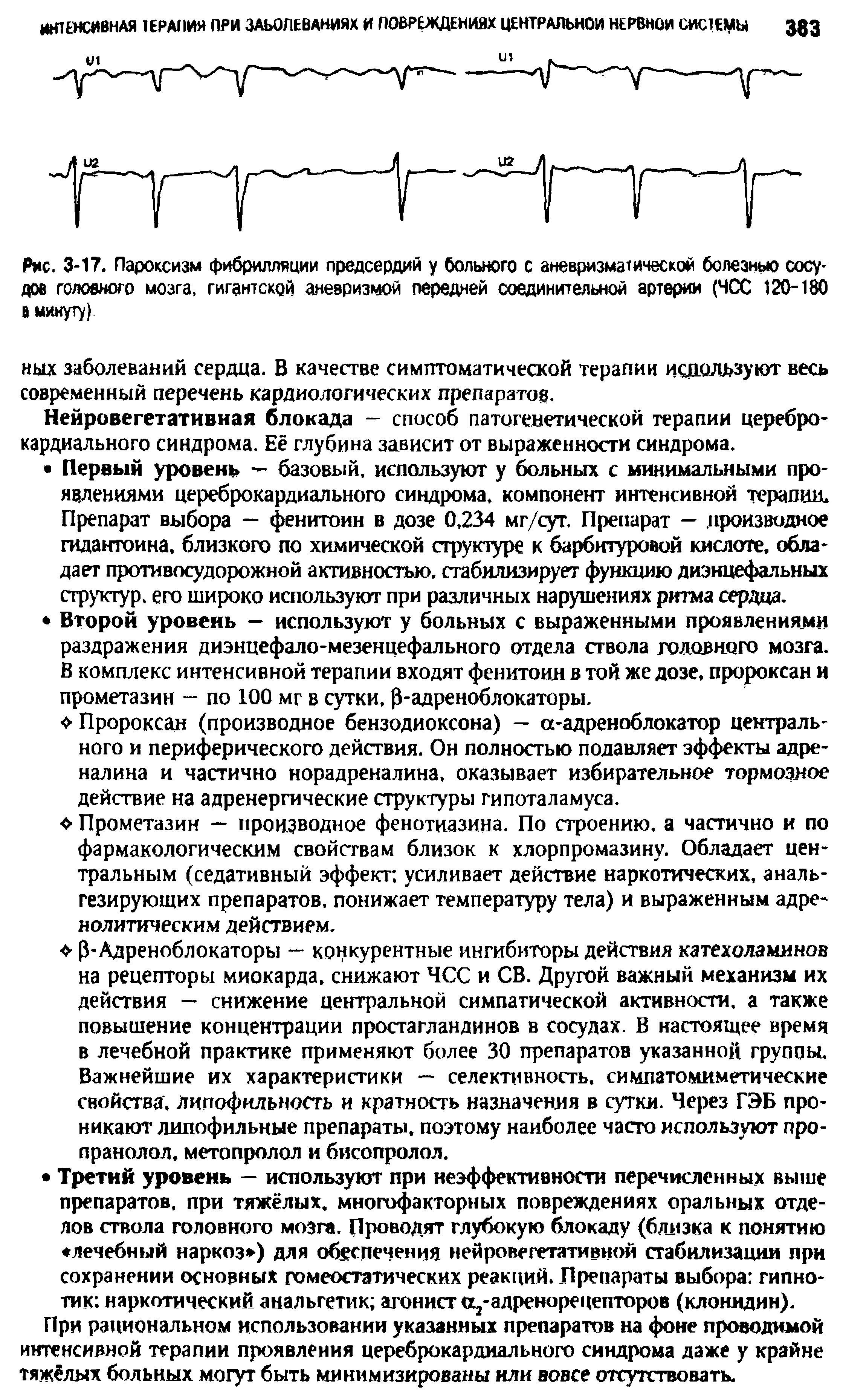 Рис. 3-17. Пароксизм фибрилляции предсердий у больного с аневризматической болезнью сосудов головного мозга, гигантской аневризмой передней соединительной артерии (ЧСС 120-180 в минуту)...