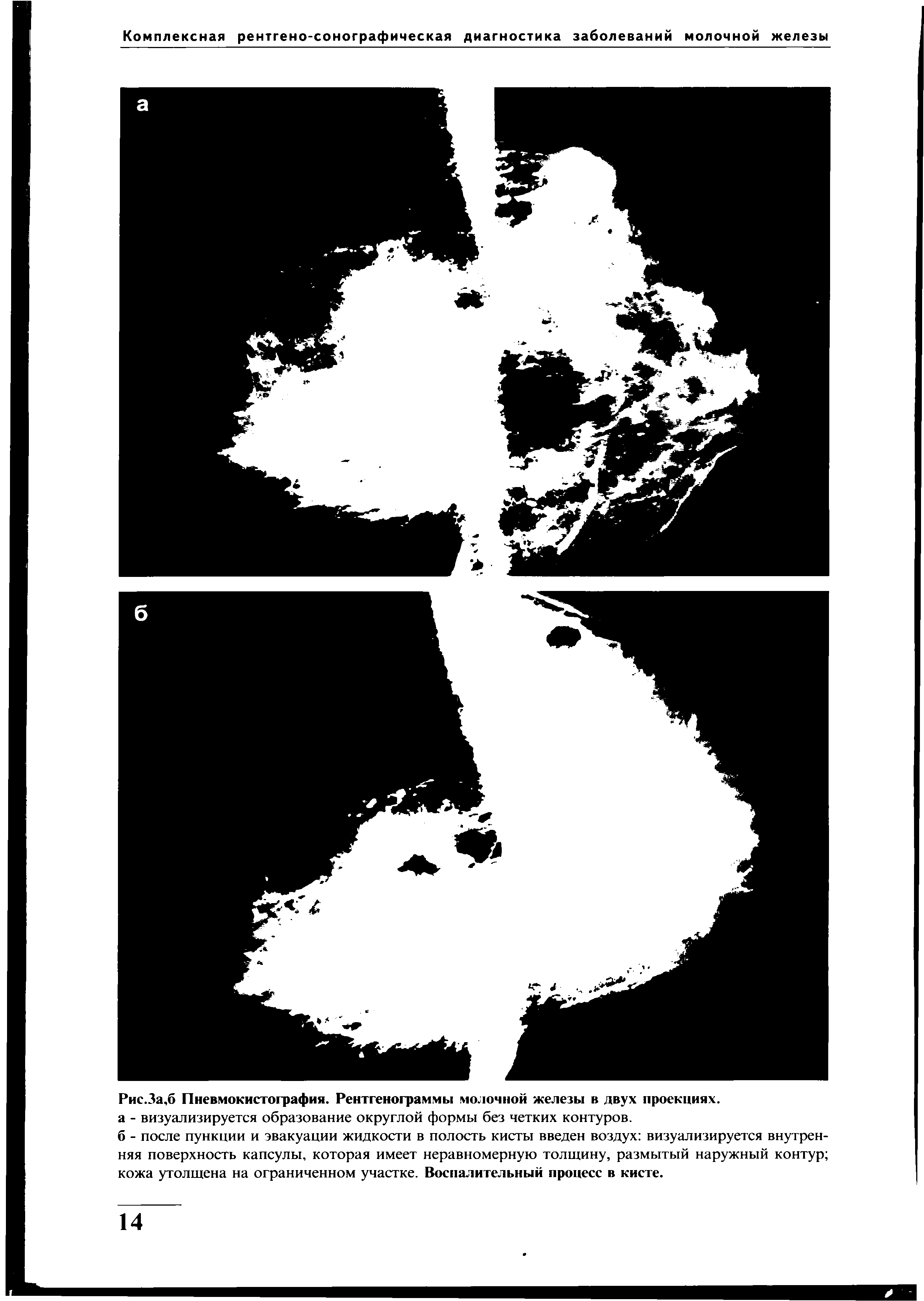 Рис.За,б Пневмокистография. Рентгенограммы молочной железы в двух проекциях.