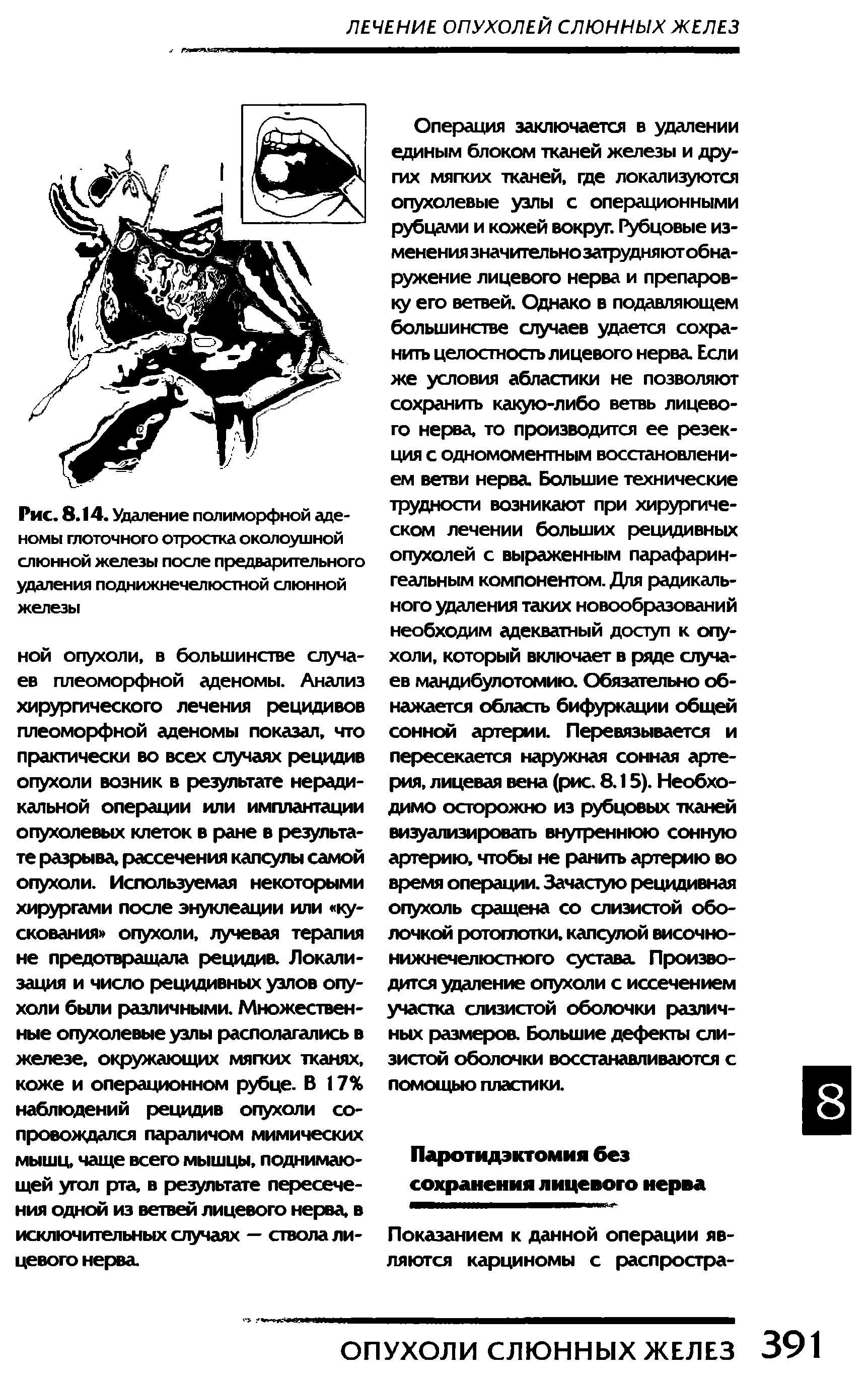 Рис. 8.14. Удаление полиморфной аденомы глоточного отростка околоушной слюнной железы после предварительного удаления поднижнечелюстной слюнной железы...