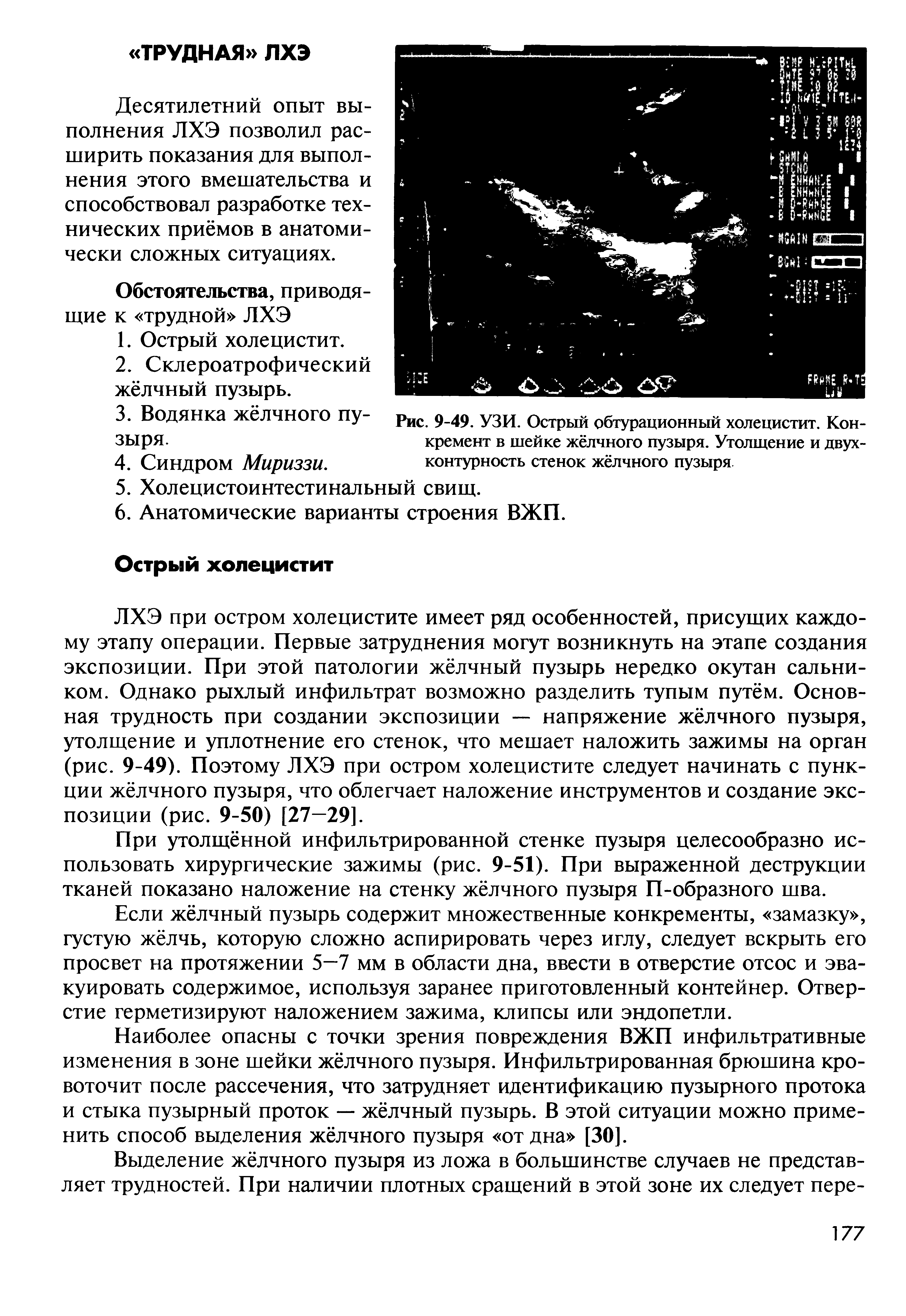 Рис. 9-49. УЗИ. Острый обтурационный холецистит. Конкремент в шейке жёлчного пузыря. Утолщение и двух-контурность стенок жёлчного пузыря...