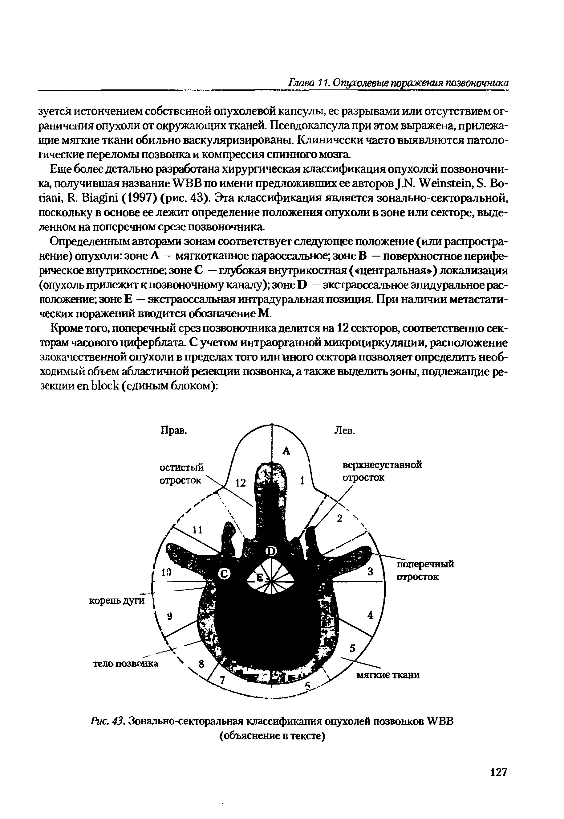 Рис. 43. Зонально-секторальная классификапия опухолей позвонков WBB (объяснение в тексте)...