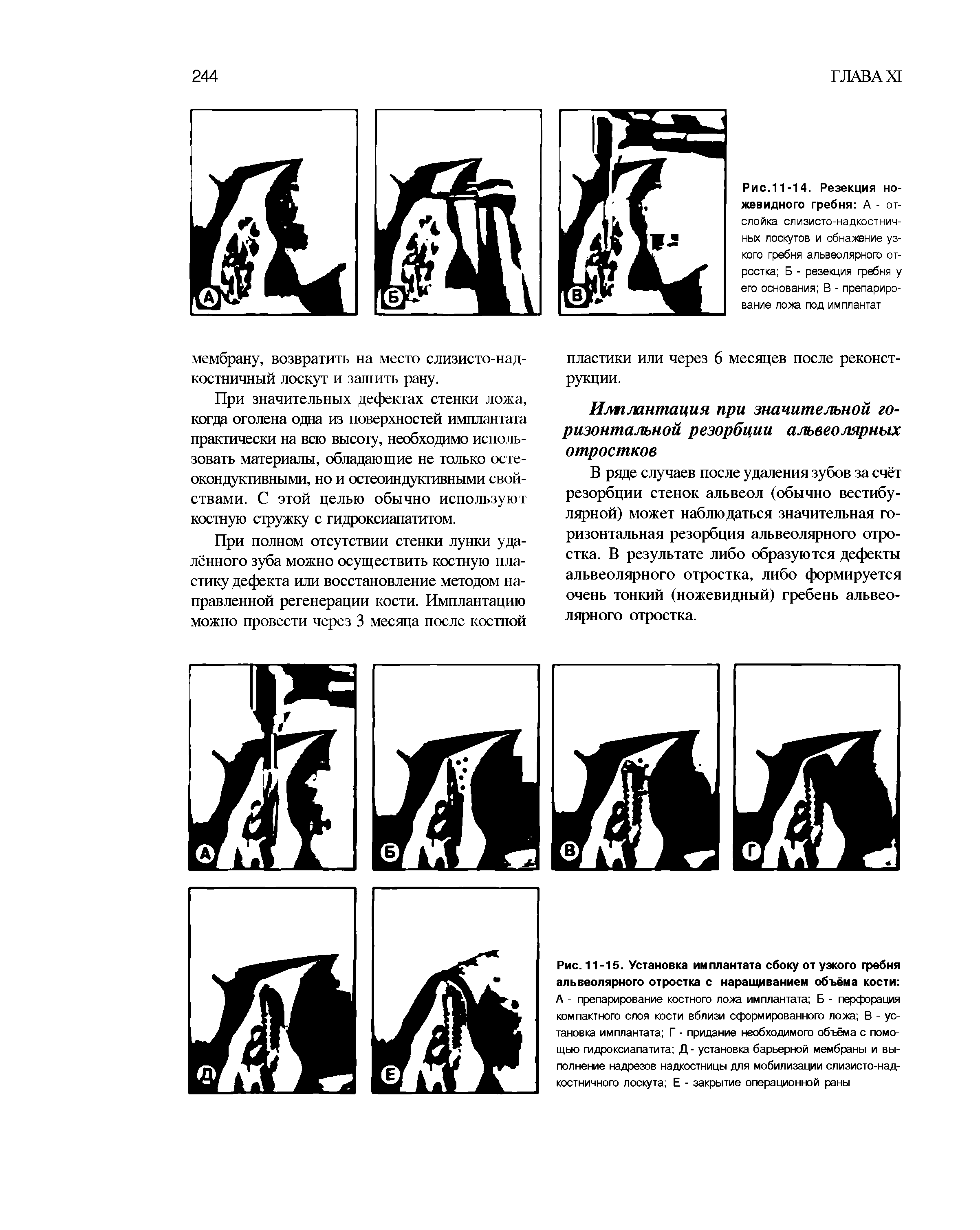 Рис.11-14. Резекция ножевидного гребня А - отслойка слизисто-надкостничных лоскутов и обнажение узкого гребня альвеолярного отростка Б - резекция гребня у его основания В - препарирование лоха под имплантат...