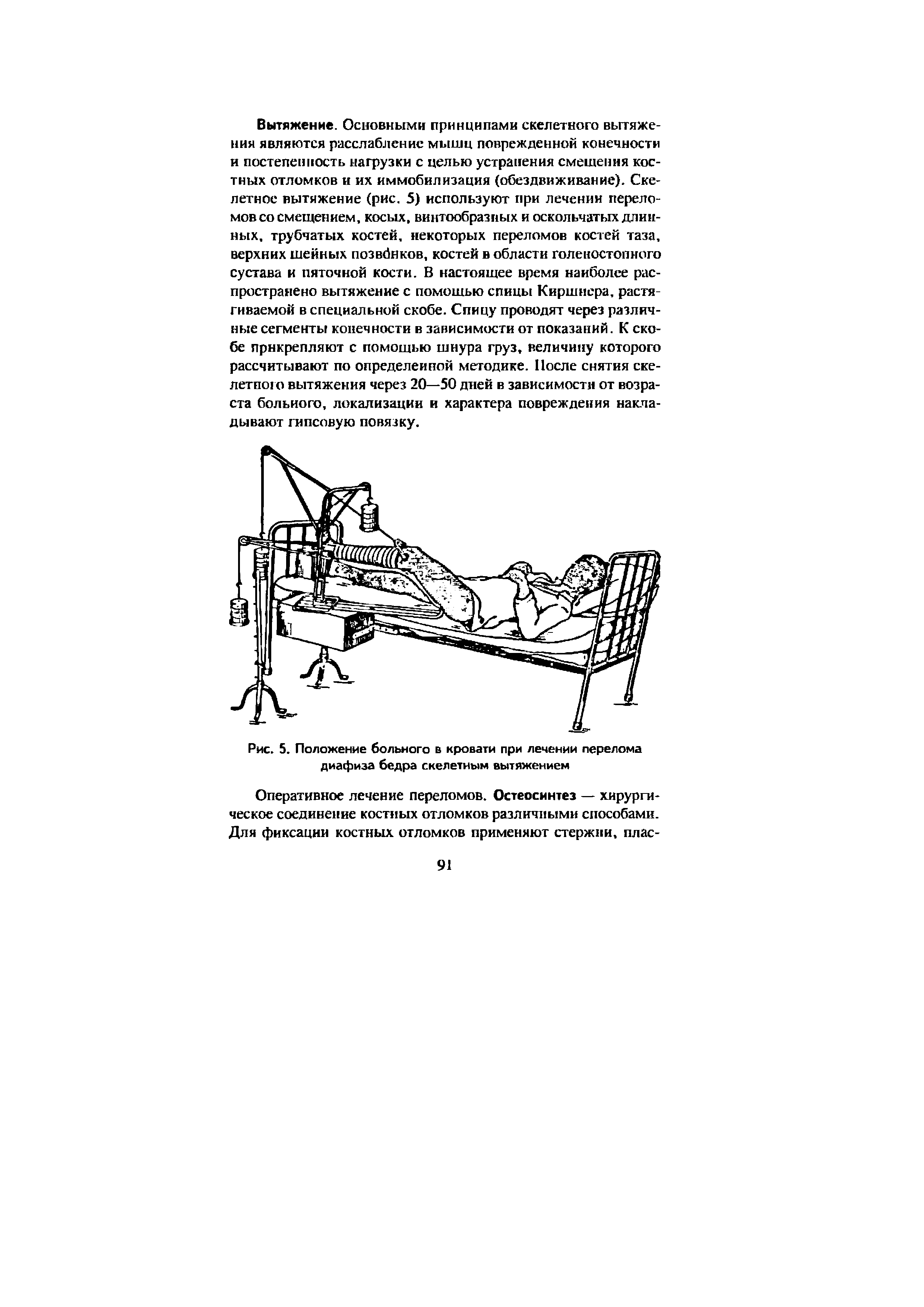 Рис. 5. Положение больного в кровати при лечении перелома диафиза бедра скелетным вытяжением...